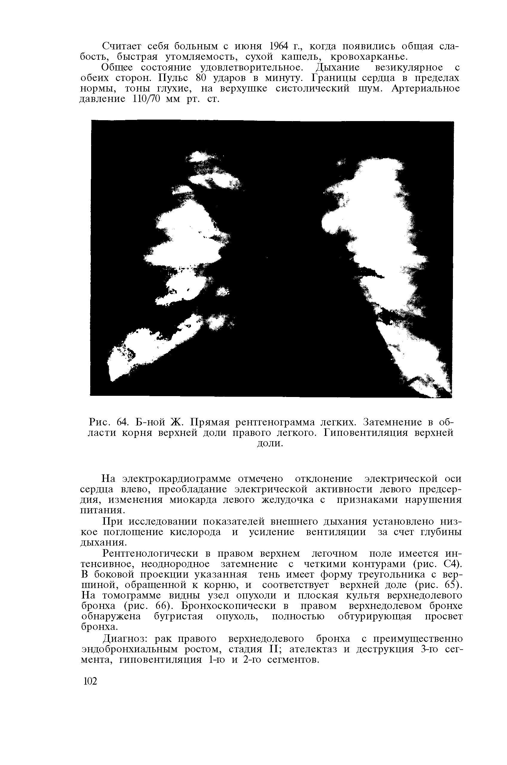 Рис. 64. Б-ной Ж. Прямая рентгенограмма легких. Затемнение в области корня верхней доли правого легкого. Гиповентиляция верхней доли.