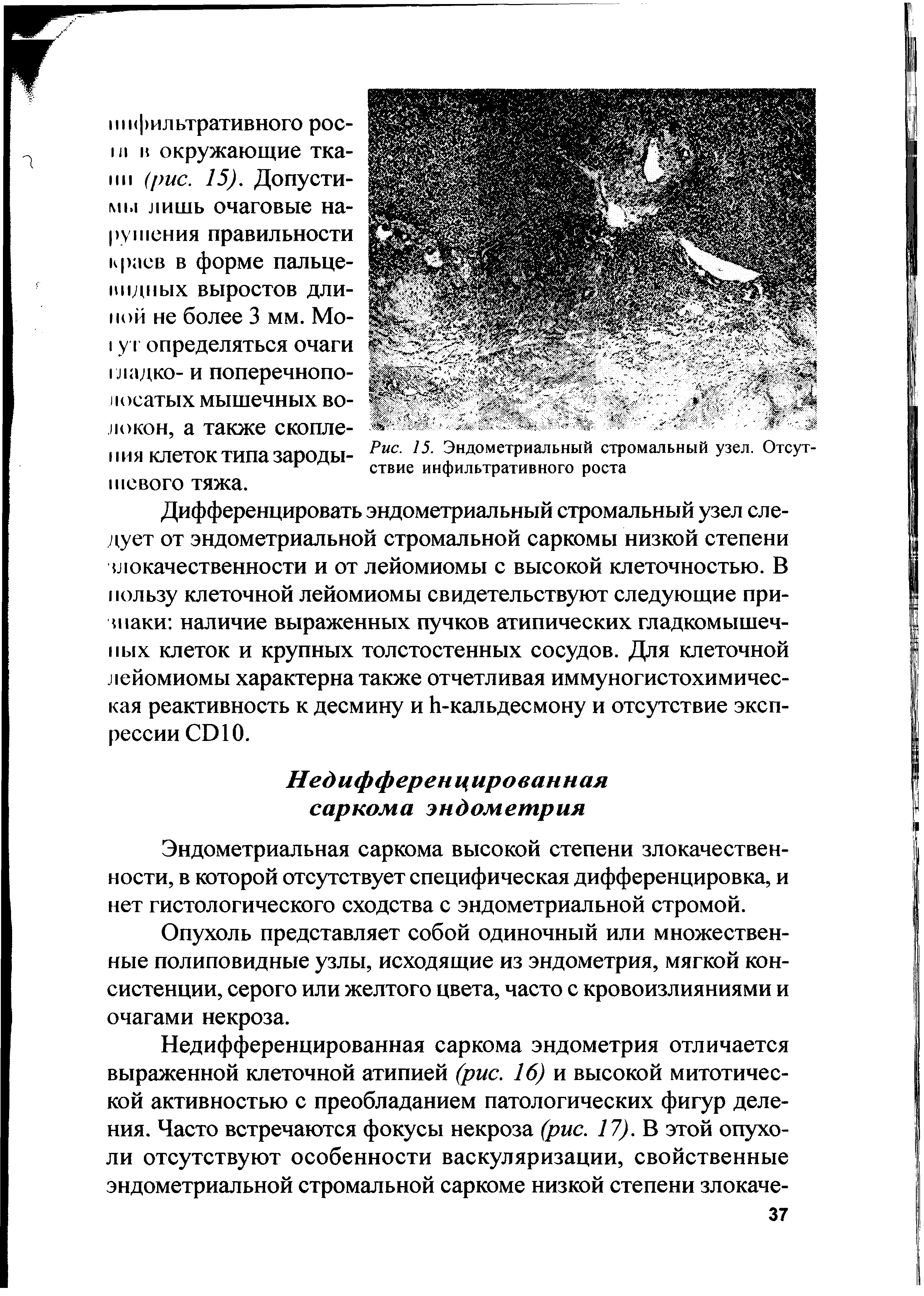 Рис. 15. Эндометриальный стромальный узел. Отсутствие инфильтративного роста...