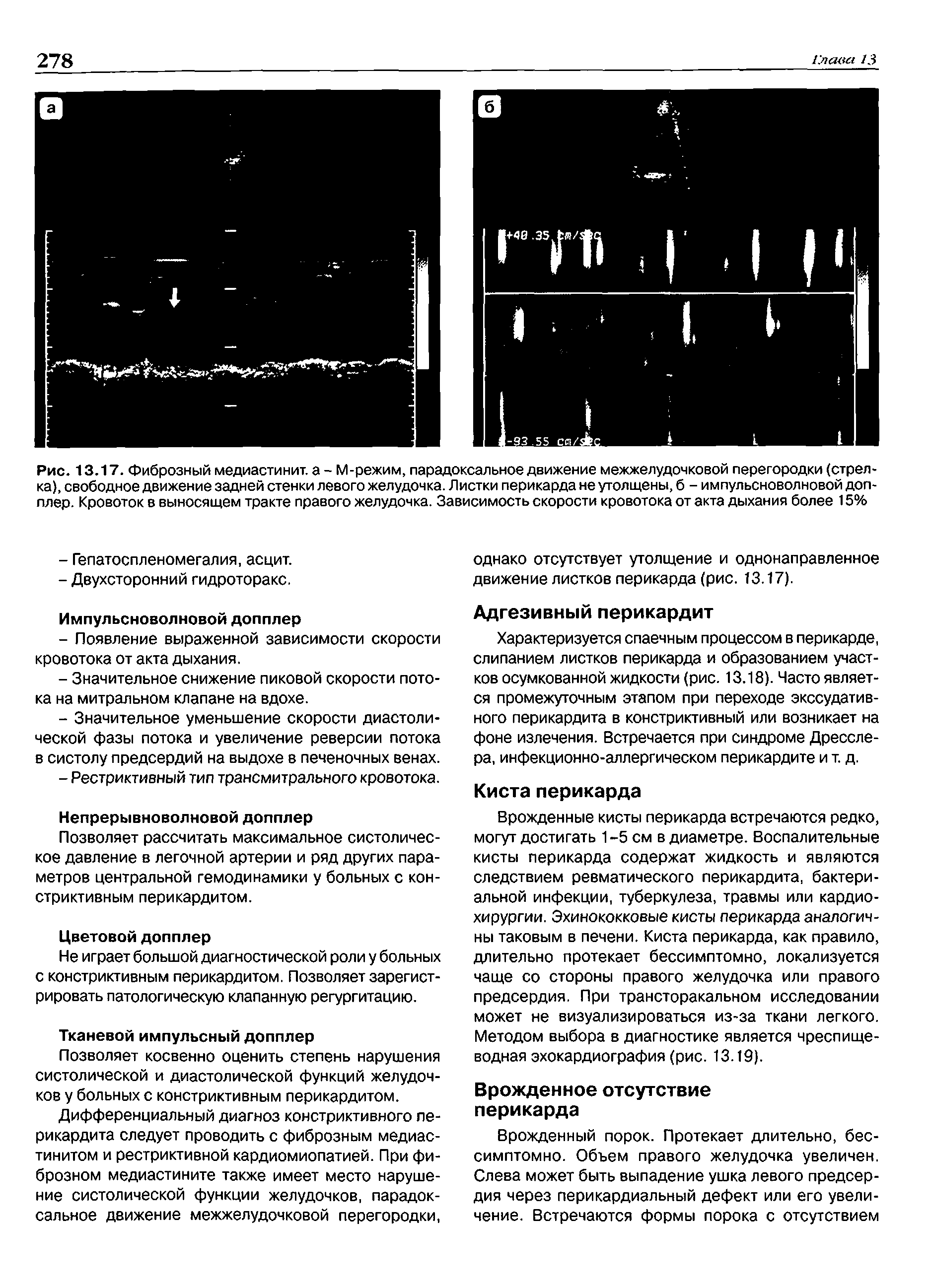 Рис. 13.17. Фиброзный медиастинит, а - М-режим, парадоксальное движение межжелудочковой перегородки (стрелка), свободное движение задней стенки левого желудочка. Листки перикарда не утолщены, б - импульсноволновой допплер. Кровоток в выносящем тракте правого желудочка. Зависимость скорости кровотока от акта дыхания более 15%...