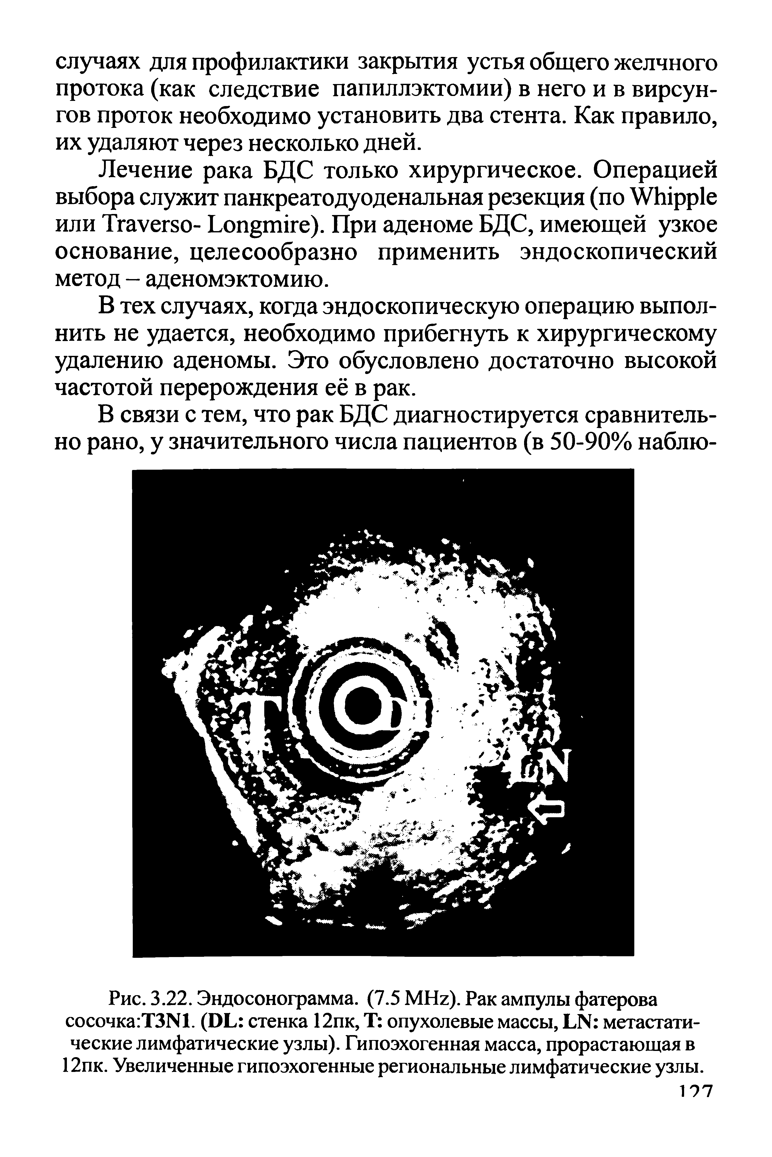 Рис. 3.22. Эндосонограмма. (7.5 MH ). Рак ампулы фатерова сосочка ТЗМ. (DL стенка 12пк, Т опухолевые массы, LN метастатические лимфатические узлы). Гипоэхогенная масса, прорастающая в 12пк. Увеличенные гипоэхогенные региональные лимфатические узлы.