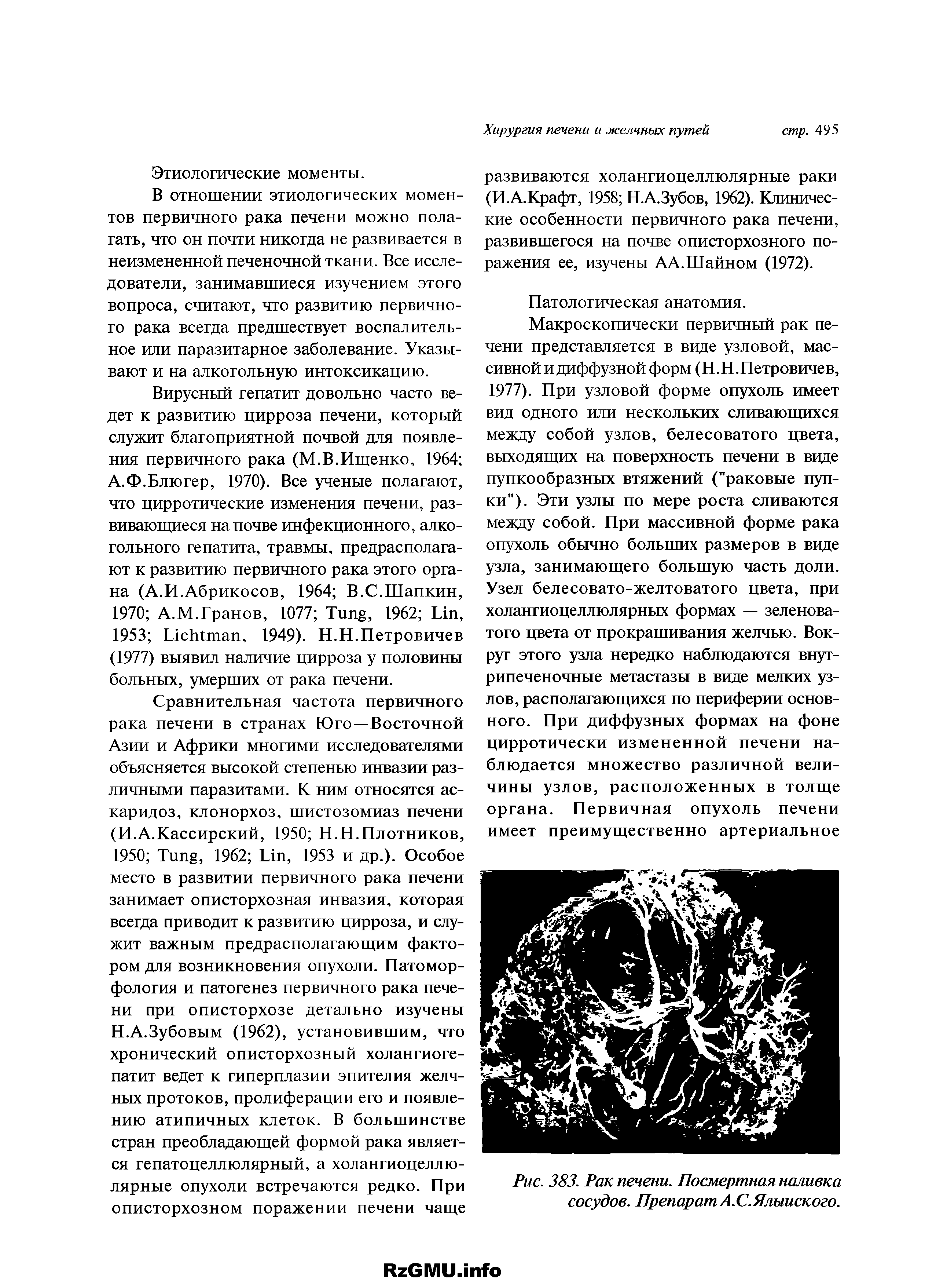 Рис. 383. Рак печени. Посмертная наливка сосудов. Препарат А.С.Ялыиского.