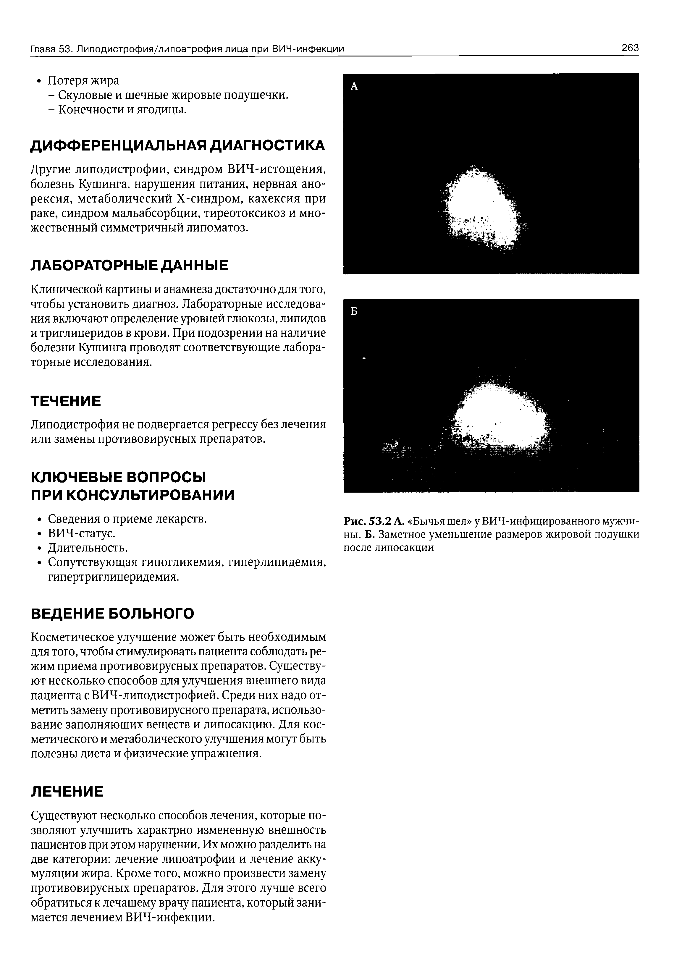 Рис. 53.2 А. Бычья шея у ВИЧ-инфицированного мужчины. Б. Заметное уменьшение размеров жировой подушки после липосакции...