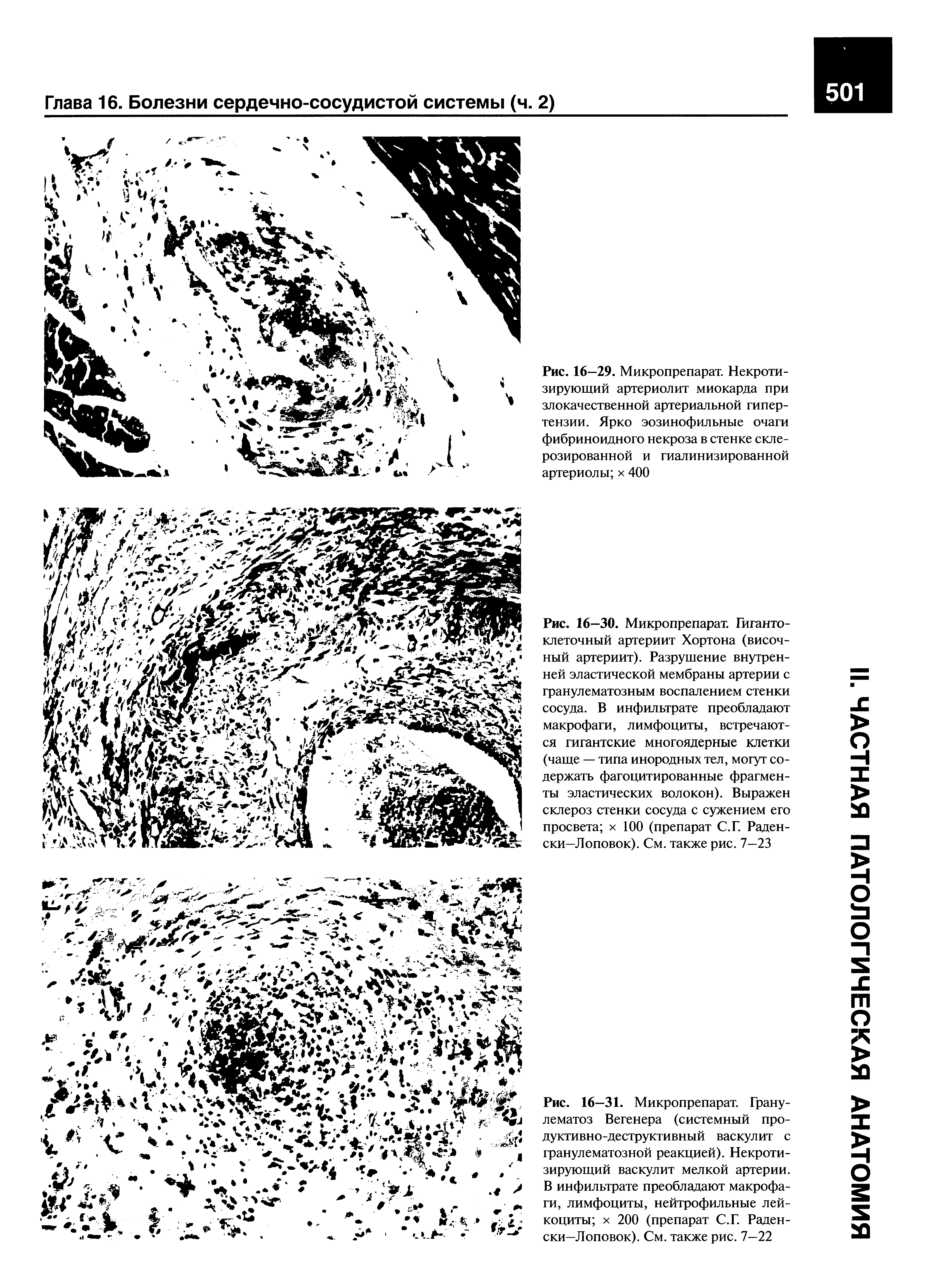 Рис. 16—31. Микропрепарат. Гранулематоз Вегенера (системный продуктивно-деструктивный васкулит с гранулематозной реакцией). Некротизирующий васкулит мелкой артерии. В инфильтрате преобладают макрофаги, лимфоциты, нейтрофильные лейкоциты х 200 (препарат С.Г. Раден-ски—Лоповок). См. также рис. 7—22...