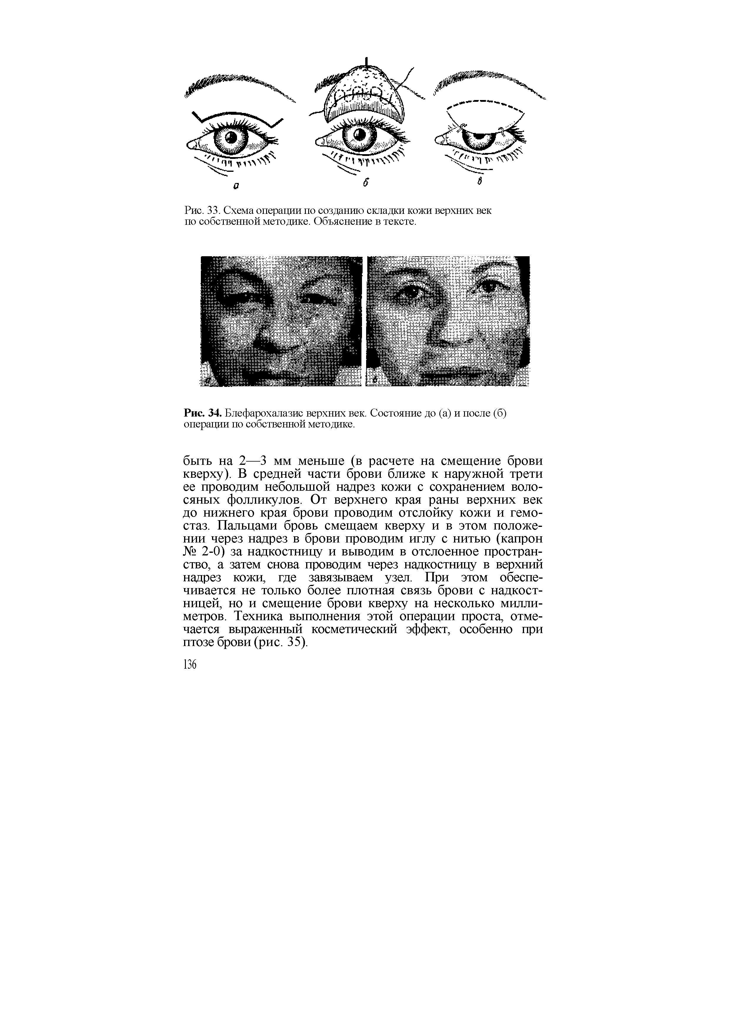 Рис. 34. Блефарохалазис верхних век. Состояние до (а) и после (б) операции по собственной методике.