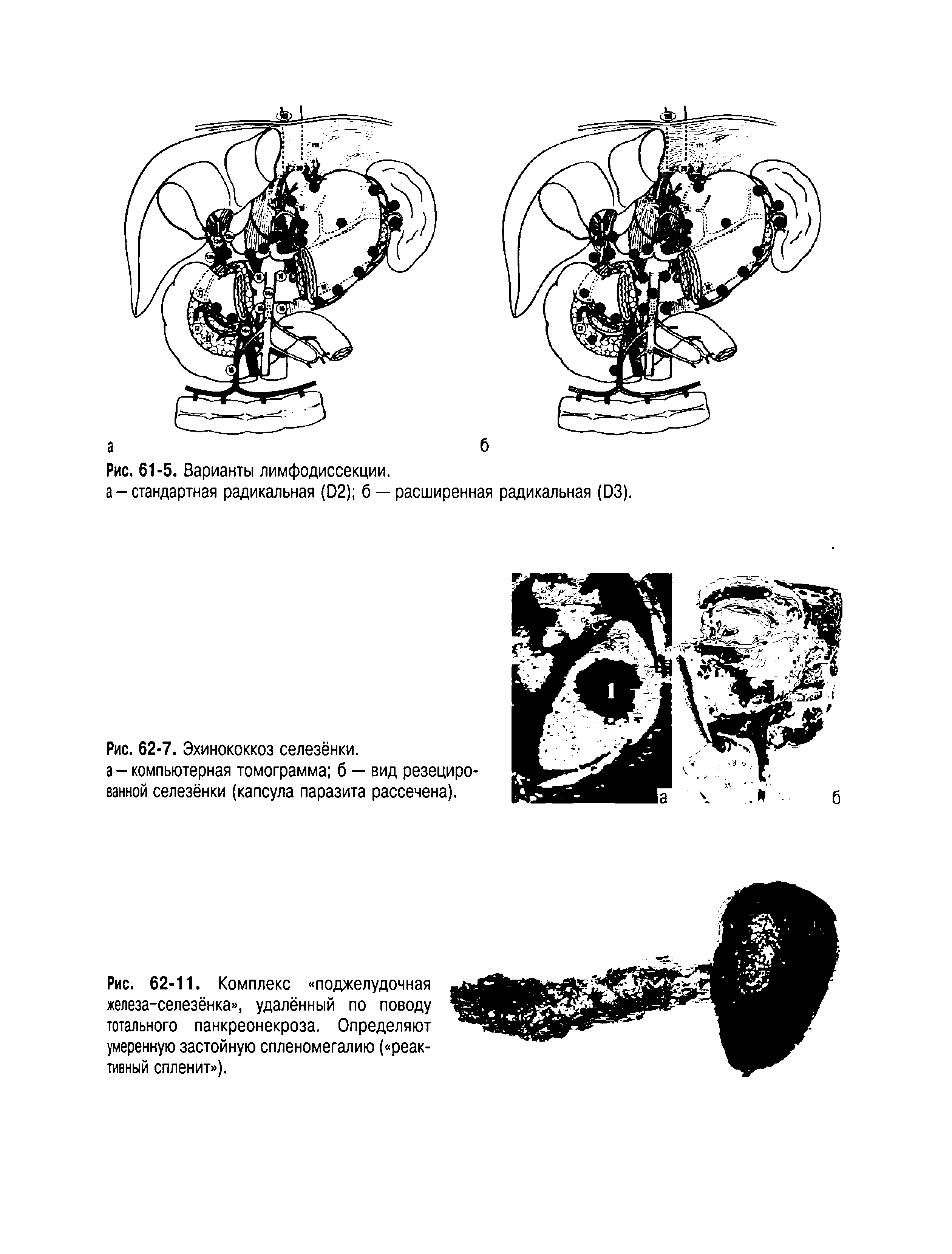 Рис. 62-11. Комплекс поджелудочная железа-селезёнка , удалённый по поводу тотального панкреонекроза. Определяют умеренную застойную спленомегалию ( реактивный спленит ).