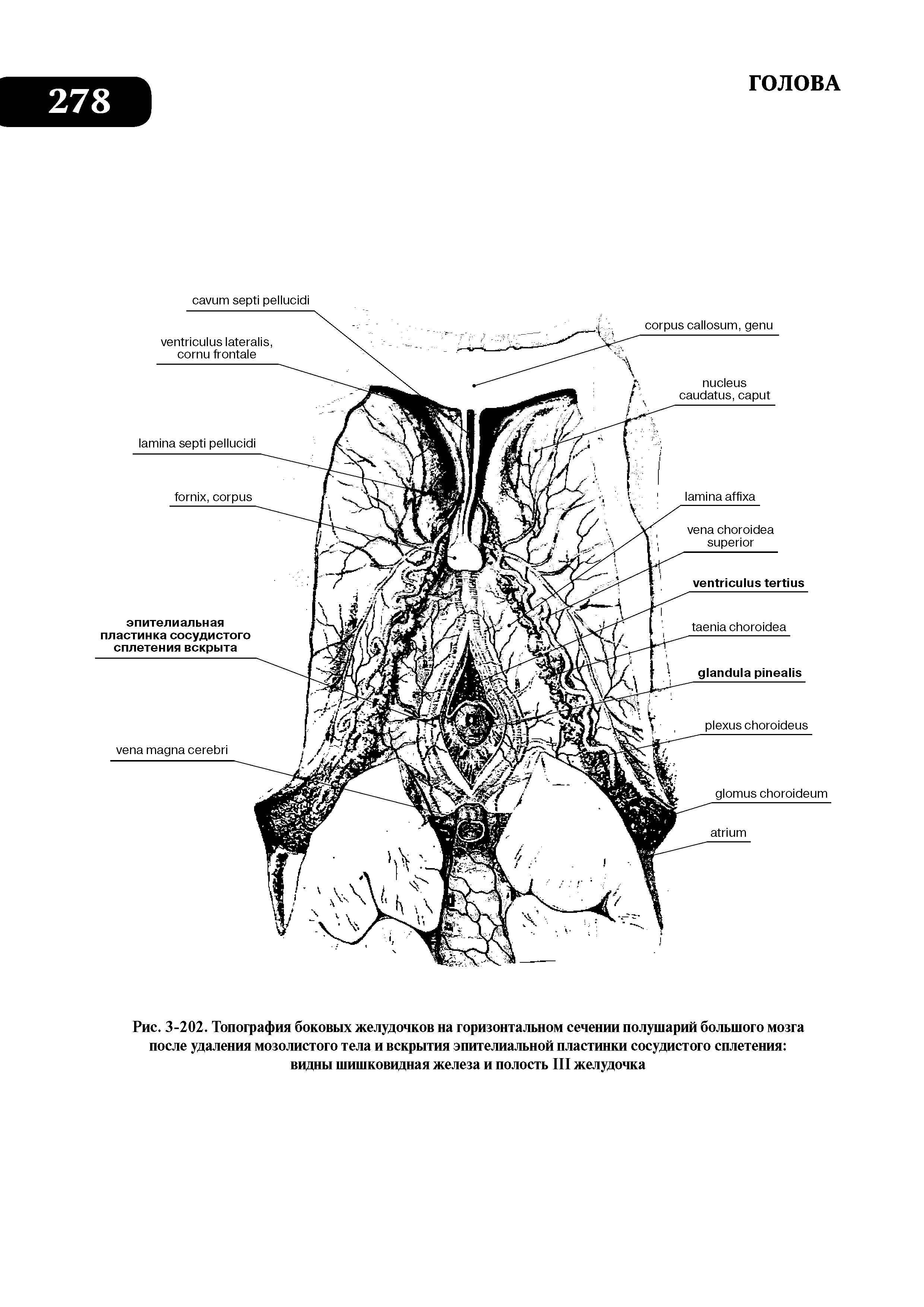Рис. 3-202. Топография боковых желудочков на горизонтальном сечении полушарий большого мозга после удаления мозолистого тела и вскрытия эпителиальной пластинки сосудистого сплетения видны шишковидная железа и полость III желудочка...