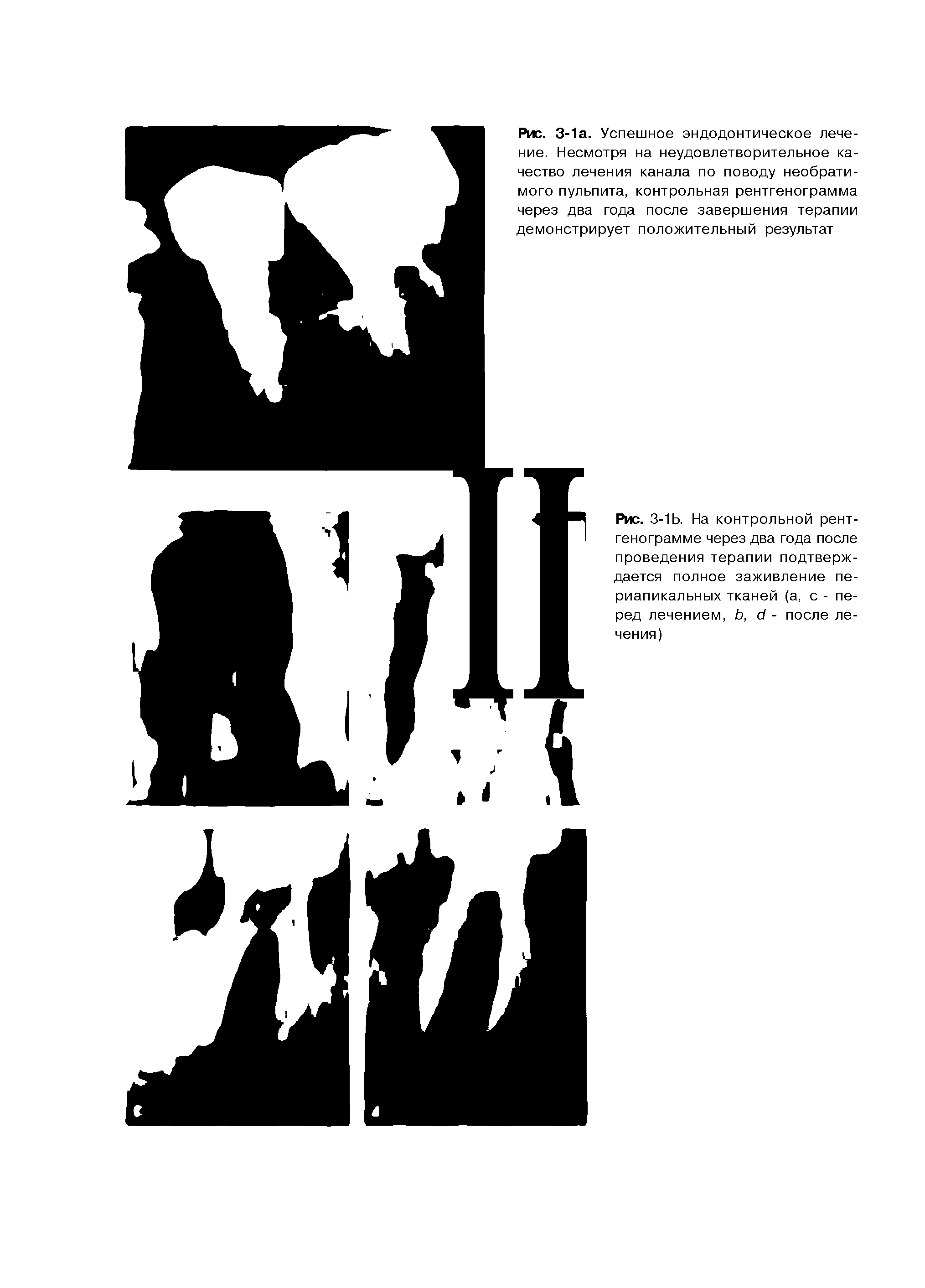 Рис. 3-1Ь. На контрольной рентгенограмме через два года после проведения терапии подтверждается полное заживление периапикальных тканей (а, с - перед лечением, Ь, с/ - после лечения)...