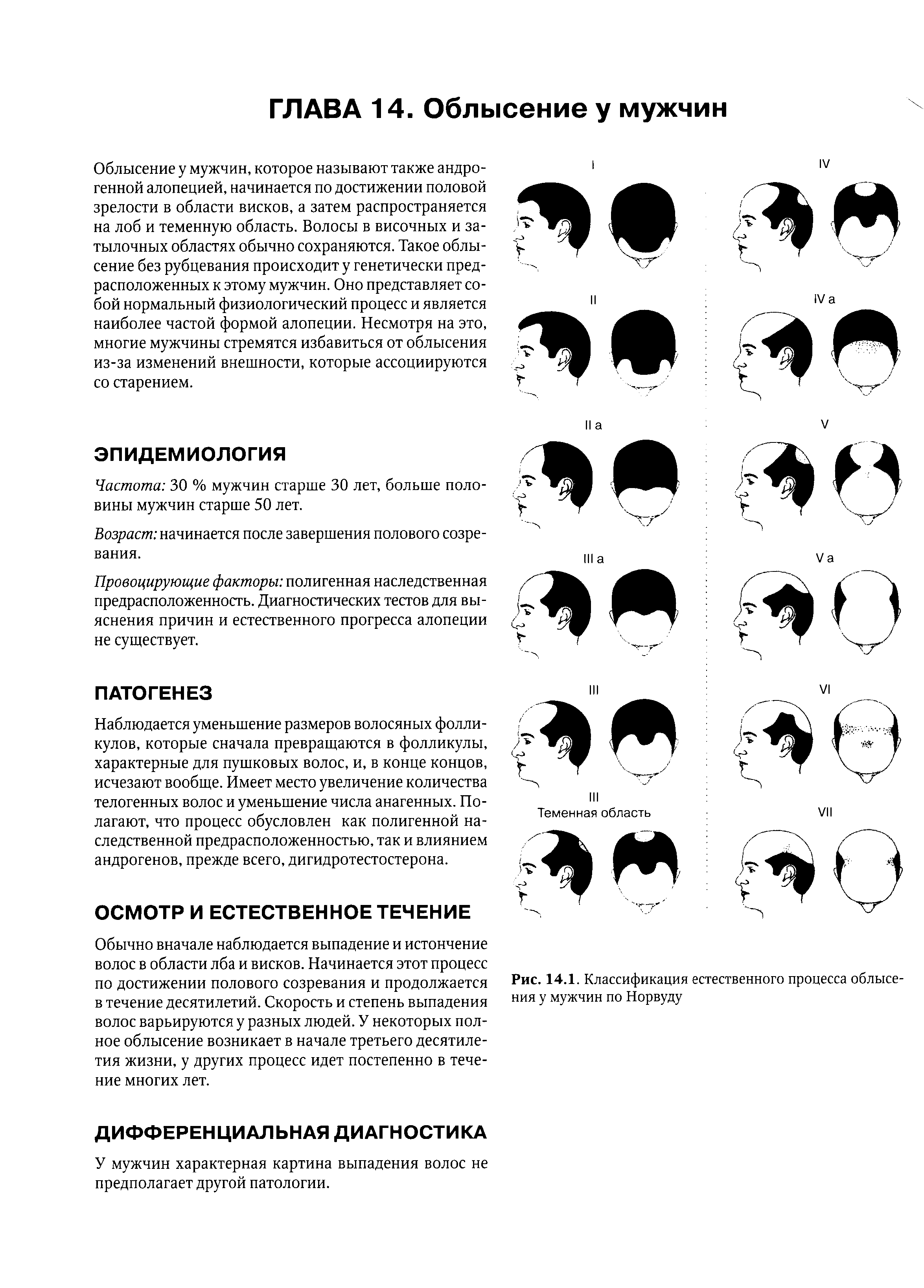 Рис. 14.1. Классификация естественного процесса облысения у мужчин по Норвуду...