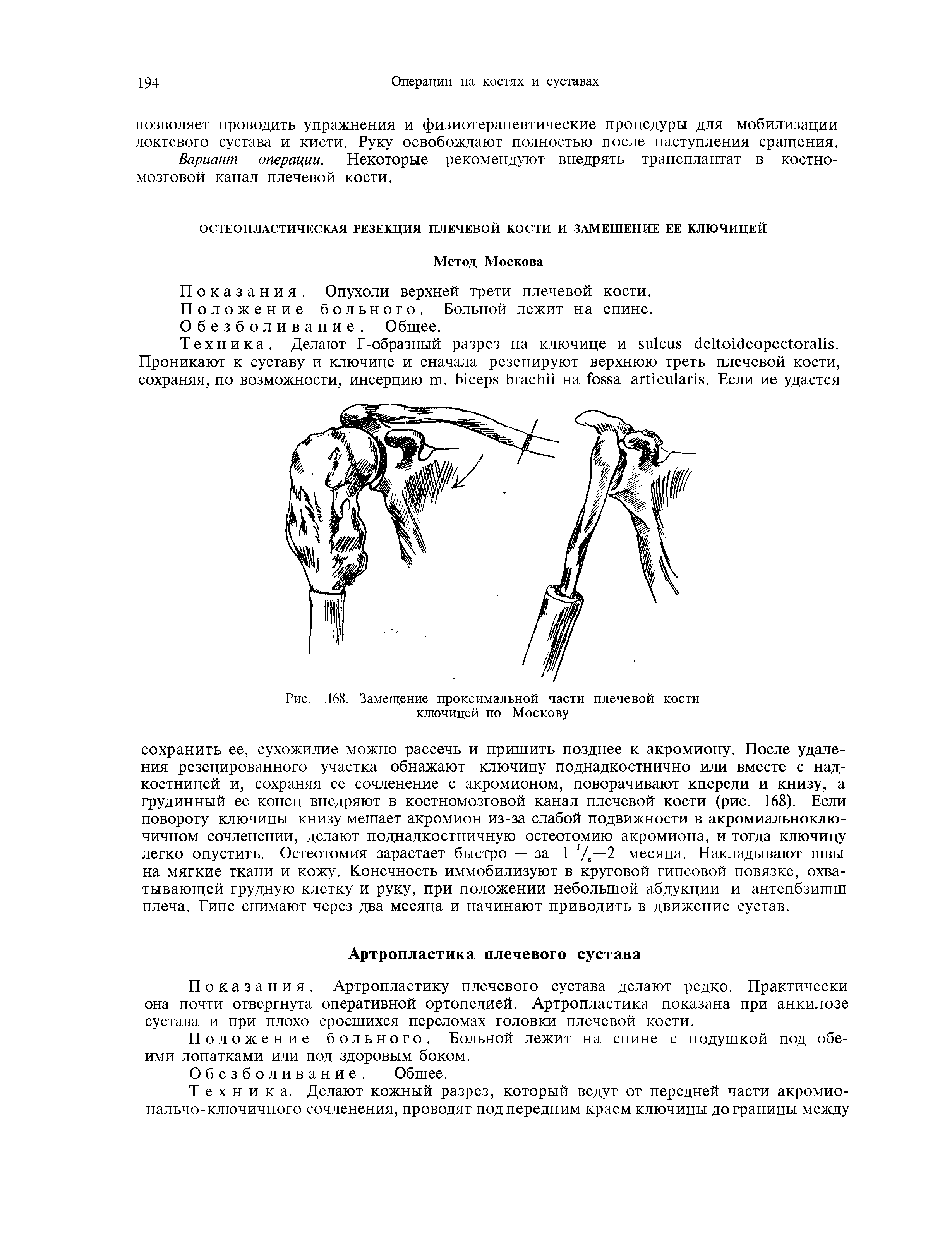 Рис.. 168. Замещение проксимальной части плечевой кости ключицей по Москову...