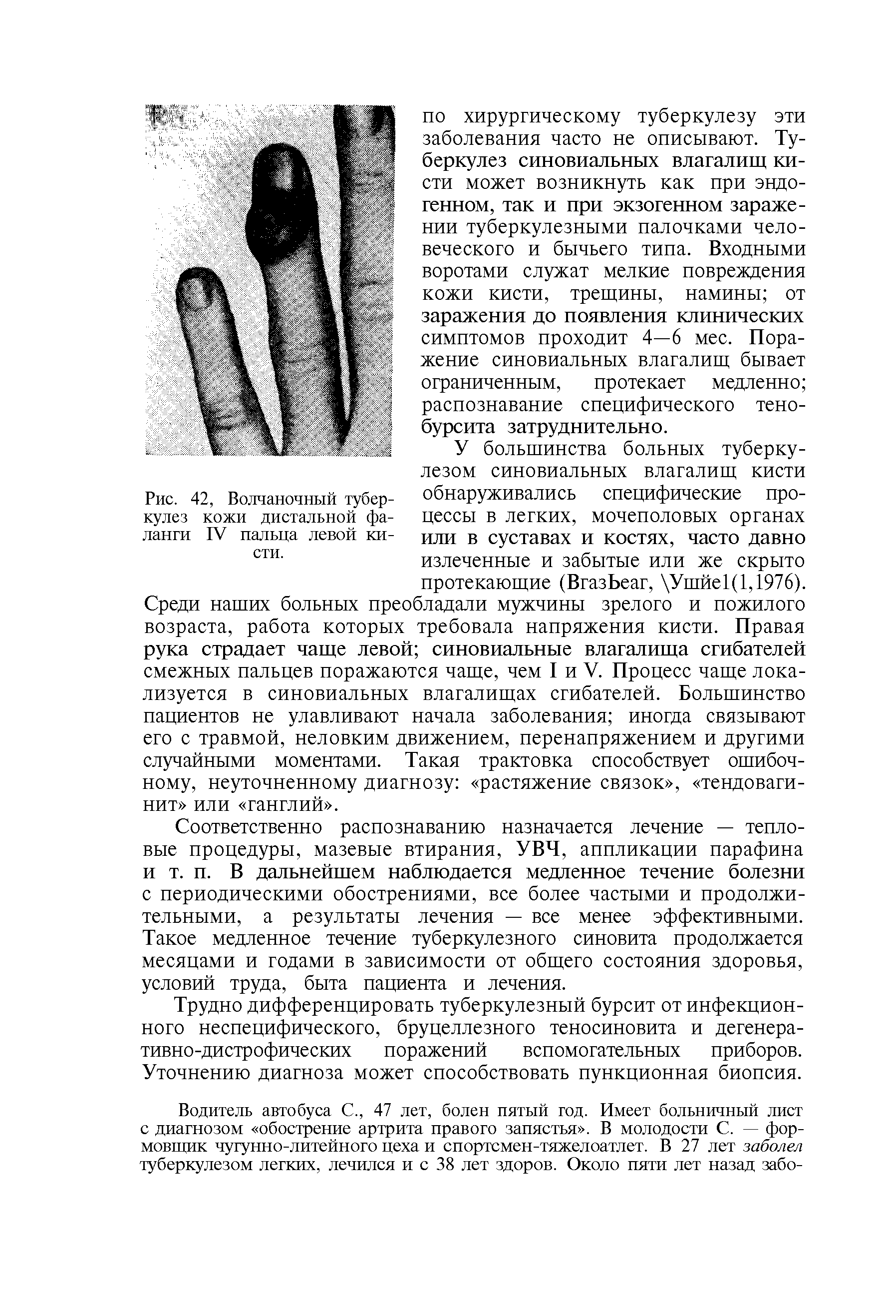 Рис. 42, Волчаночный тубер- обнаруживались специфические про-кулез кожи дистальной фа- цессы в легких, мочеполовых органах ланги IV пальца левой ки- или в суставах и костях, часто давно сти излеченные и забытые или же скрыто...