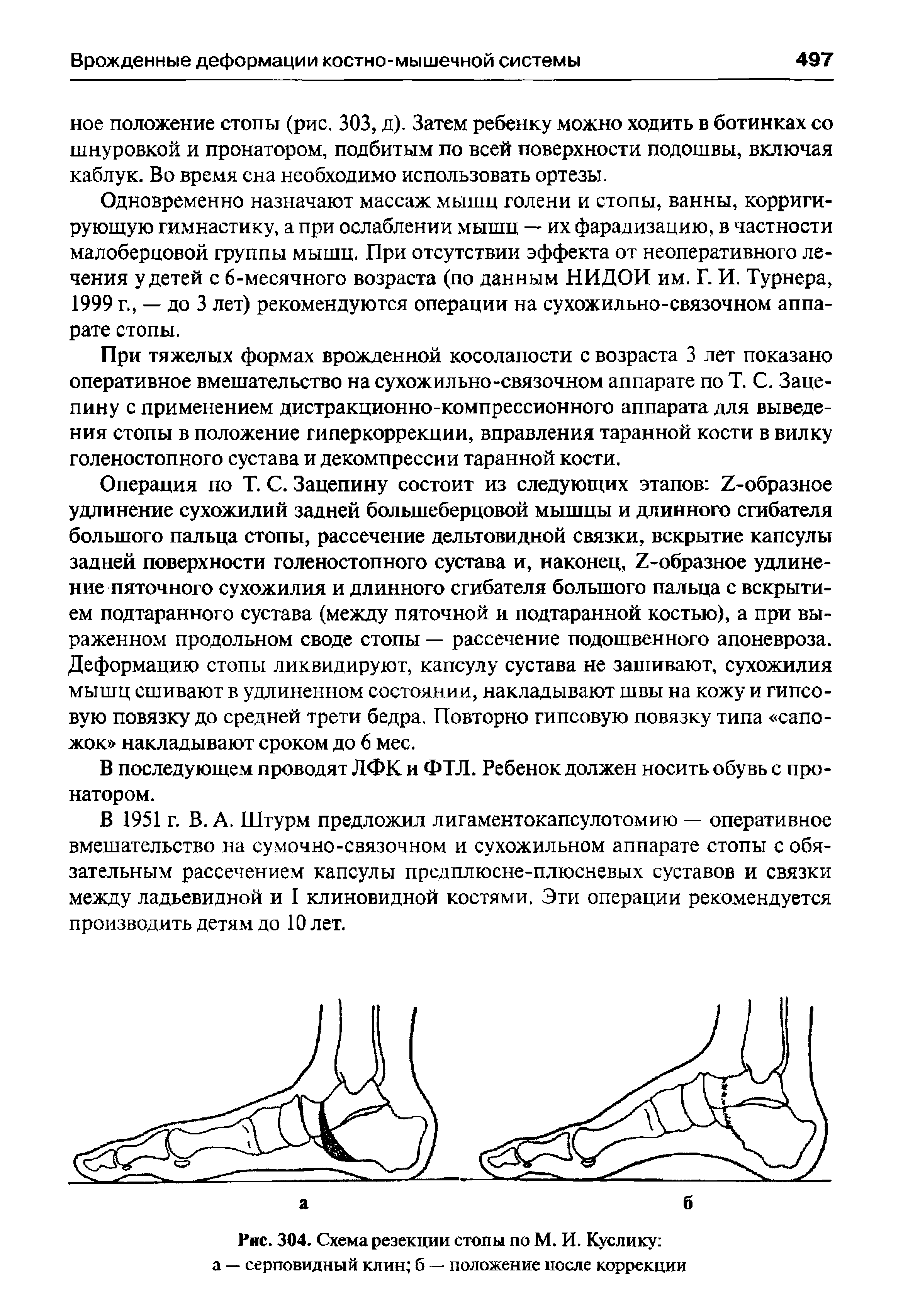 Рис. 304. Схема резекции стопы по М. И. Куслику а — серповидный клин б — положение после коррекции...