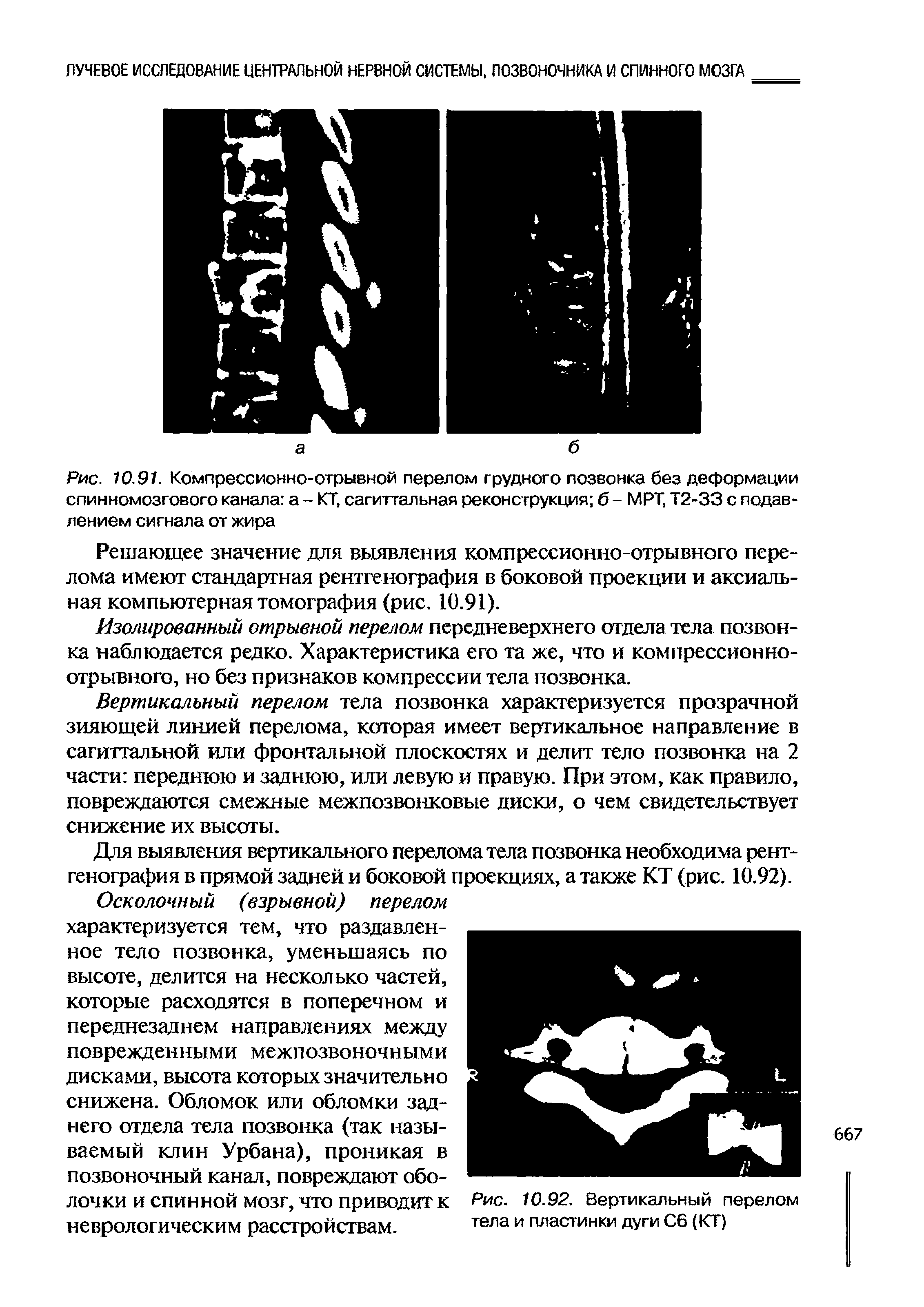 Рис. 10.91. Компрессионно-отрывной перелом грудного позвонка без деформации спинномозгового канала а - КТ, сагиттальная реконструкция б - MPT, Т2-33 с подавлением сигнала от жира...
