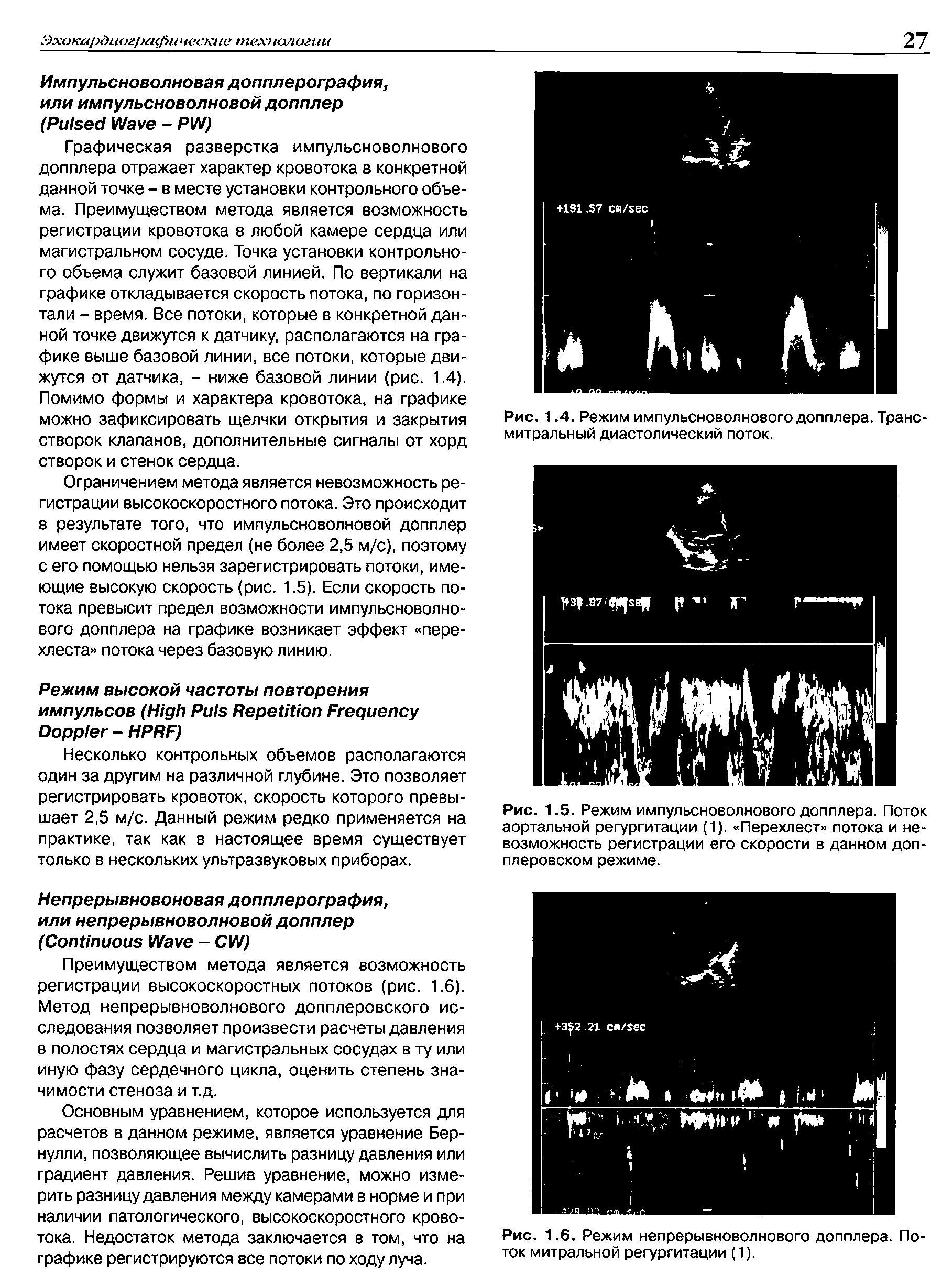 Рис. 1.5. Режим импульсноволнового допплера. Поток аортальной регургитации (1). Перехлест потока и невозможность регистрации его скорости в данном допплеровском режиме.