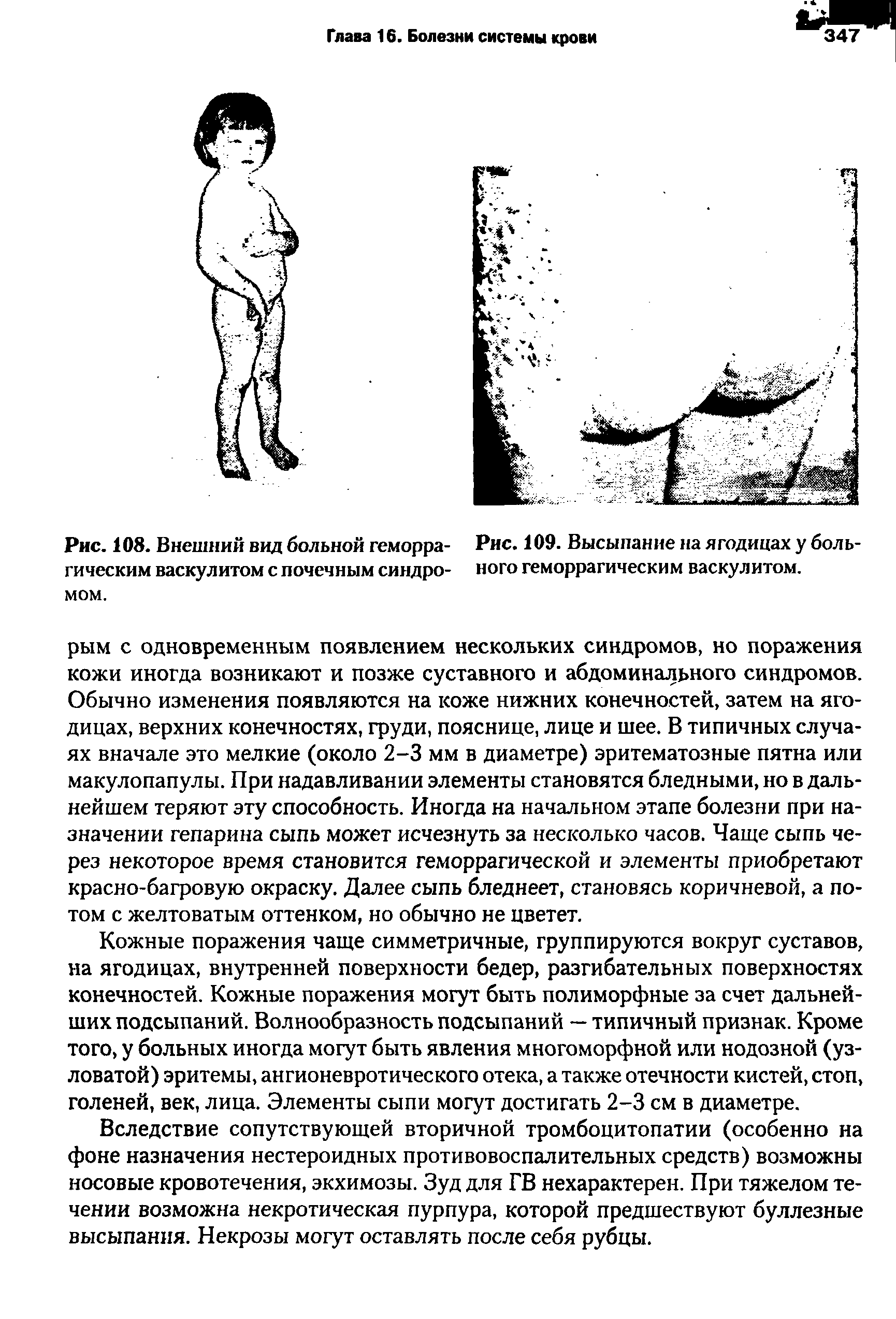 Рис. 108. Внешний вид больной геморра- Рис. 109. Высыпание на ягодицах у боль-гическим васкулитом с почечным синдро- ного геморрагическим васкулитом, мом.