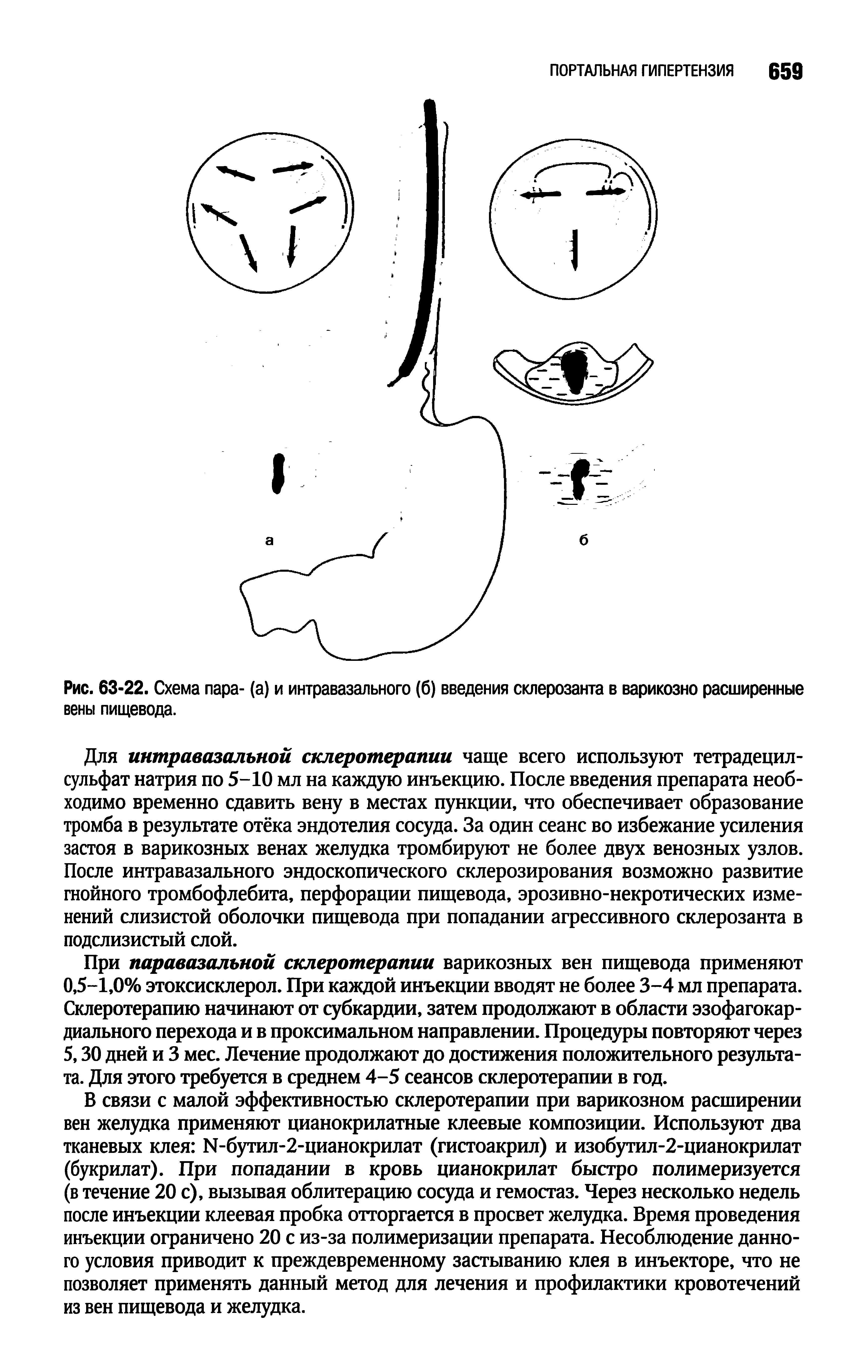 Рис. 63-22. Схема пара- (а) и интравазального (б) введения склерозанта в варикозно расширенные вены пищевода.