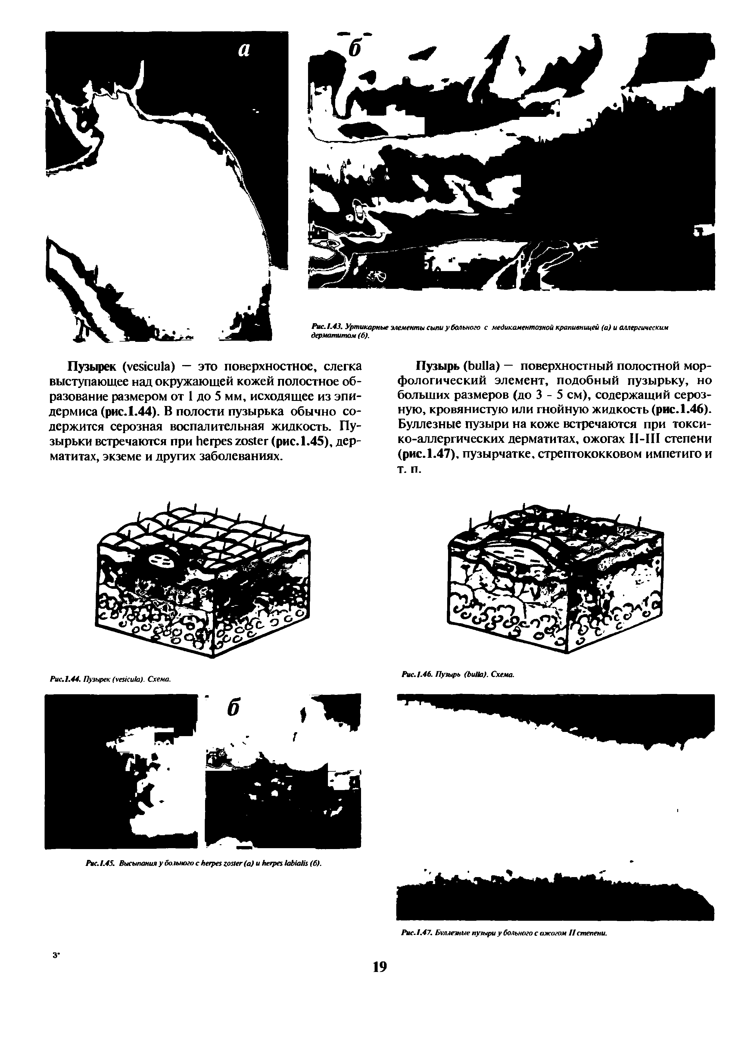 Рис. 1.45. Высыпания у больного с (а) и (б).