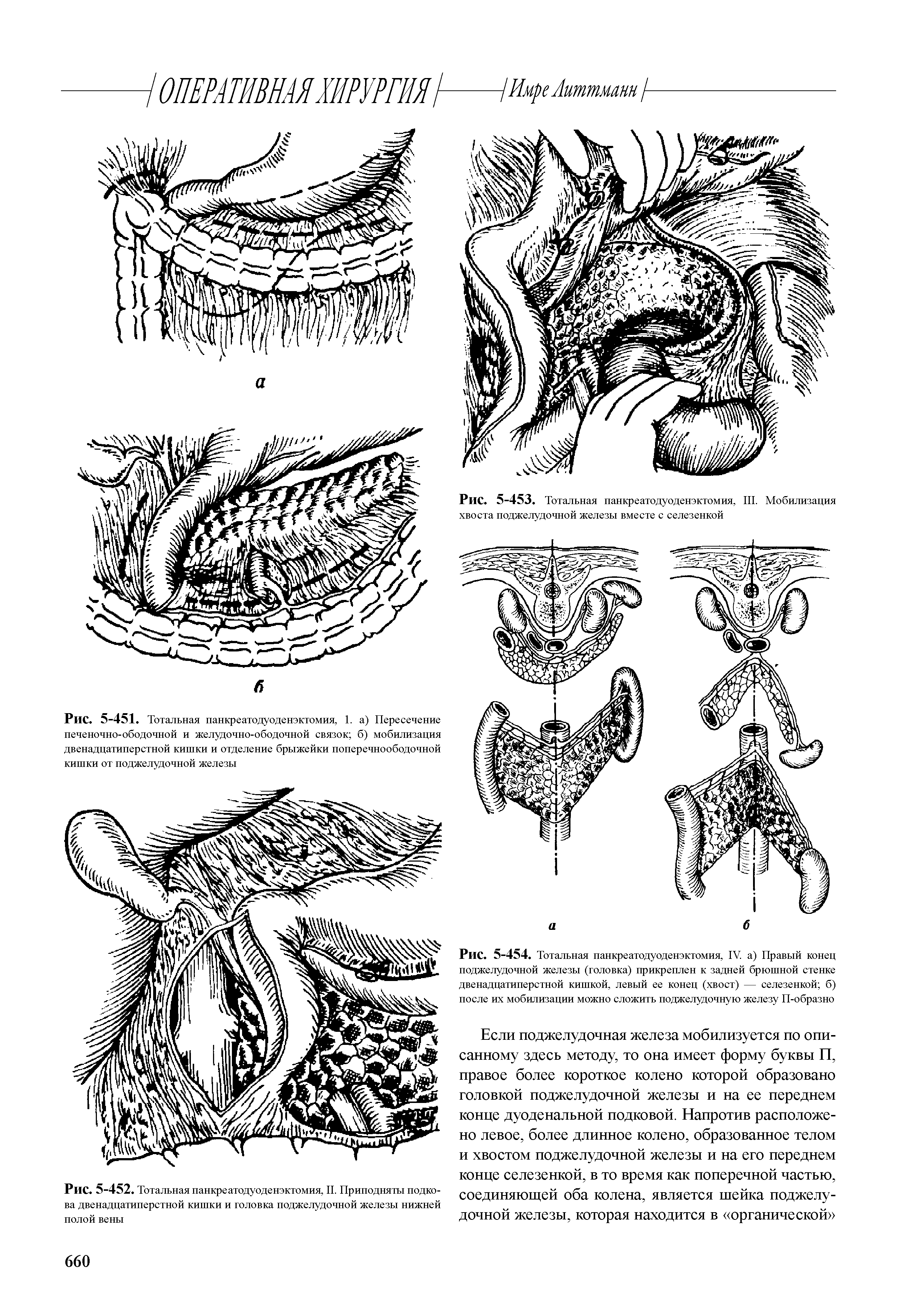 Рис. 5-454. Тотальная панкреатодуоденэктомия, IV. а) Правый конец поджелудочной железы (головка) прикреплен к задней брюшной стенке двенадцатиперстной кишкой, левый ее конец (хвост) — селезенкой б) после их мобилизации можно сложить поджелудочную железу П-образно...