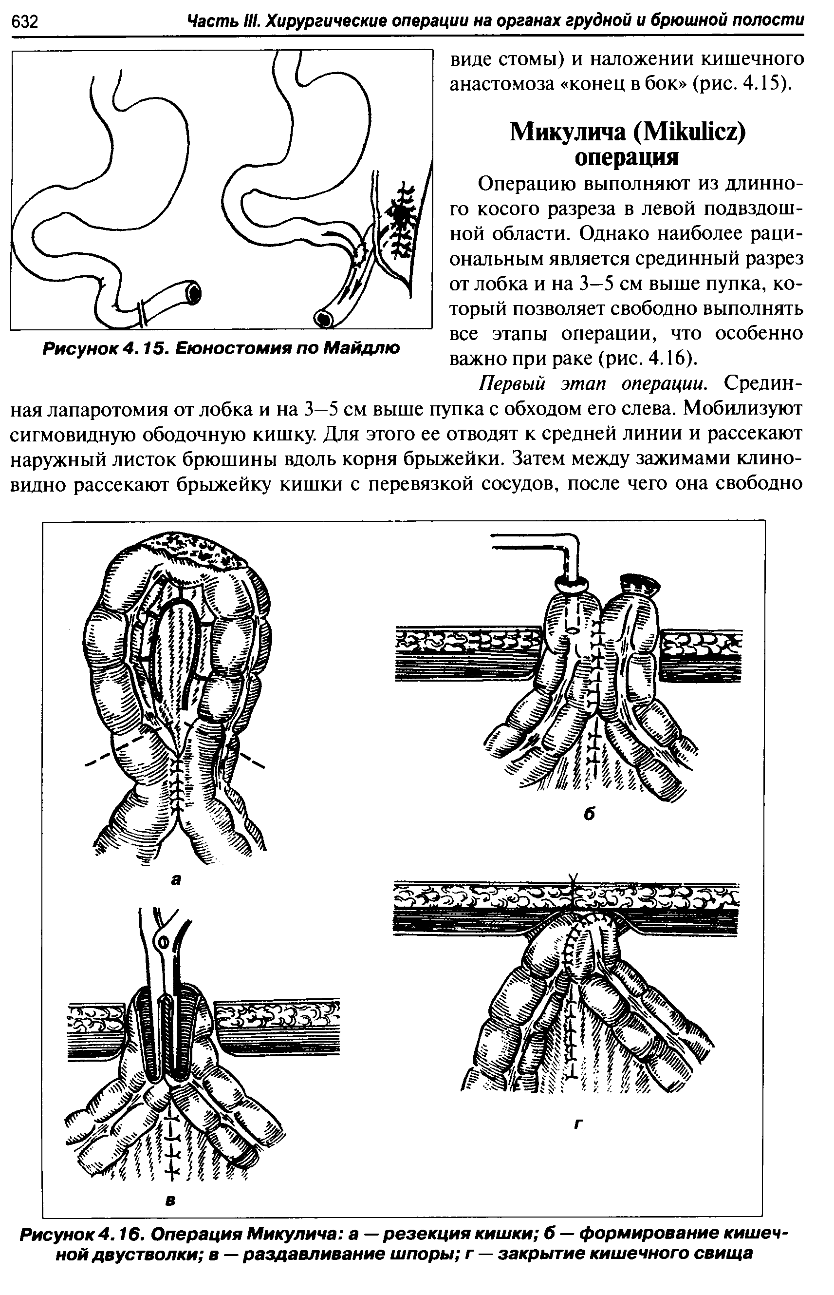 Рисунок 4.16. Операция Микулича а — резекция кишки б — формирование кишечной двустволки в — раздавливание шпоры г — закрытие кишечного свища...