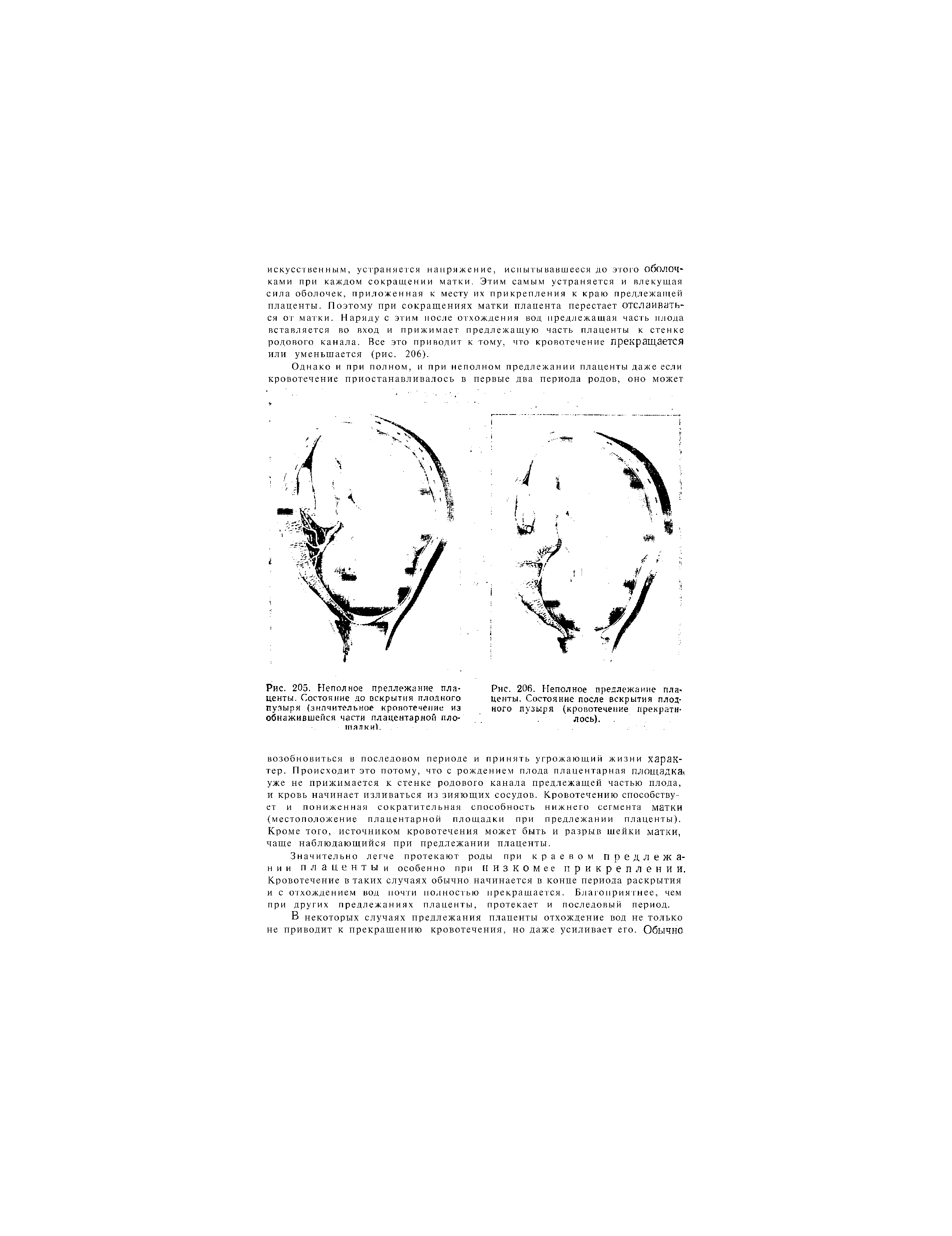 Рис. 205. Неполное предлежание плаценты. Состояние до вскрытия плодного пузыря (значительное кровотечение из обнажившейся части плацентарной пло-тпялки).