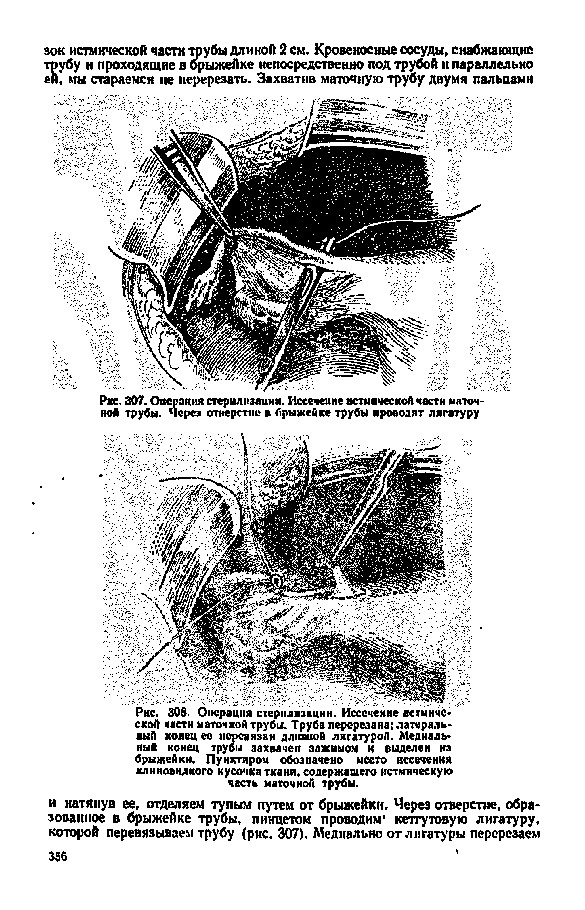 Рис. 307. Операция стерилизации. Иссечение истмической части маточной трубы. Через отверстие в брыжейке трубы проводят лигатуру...