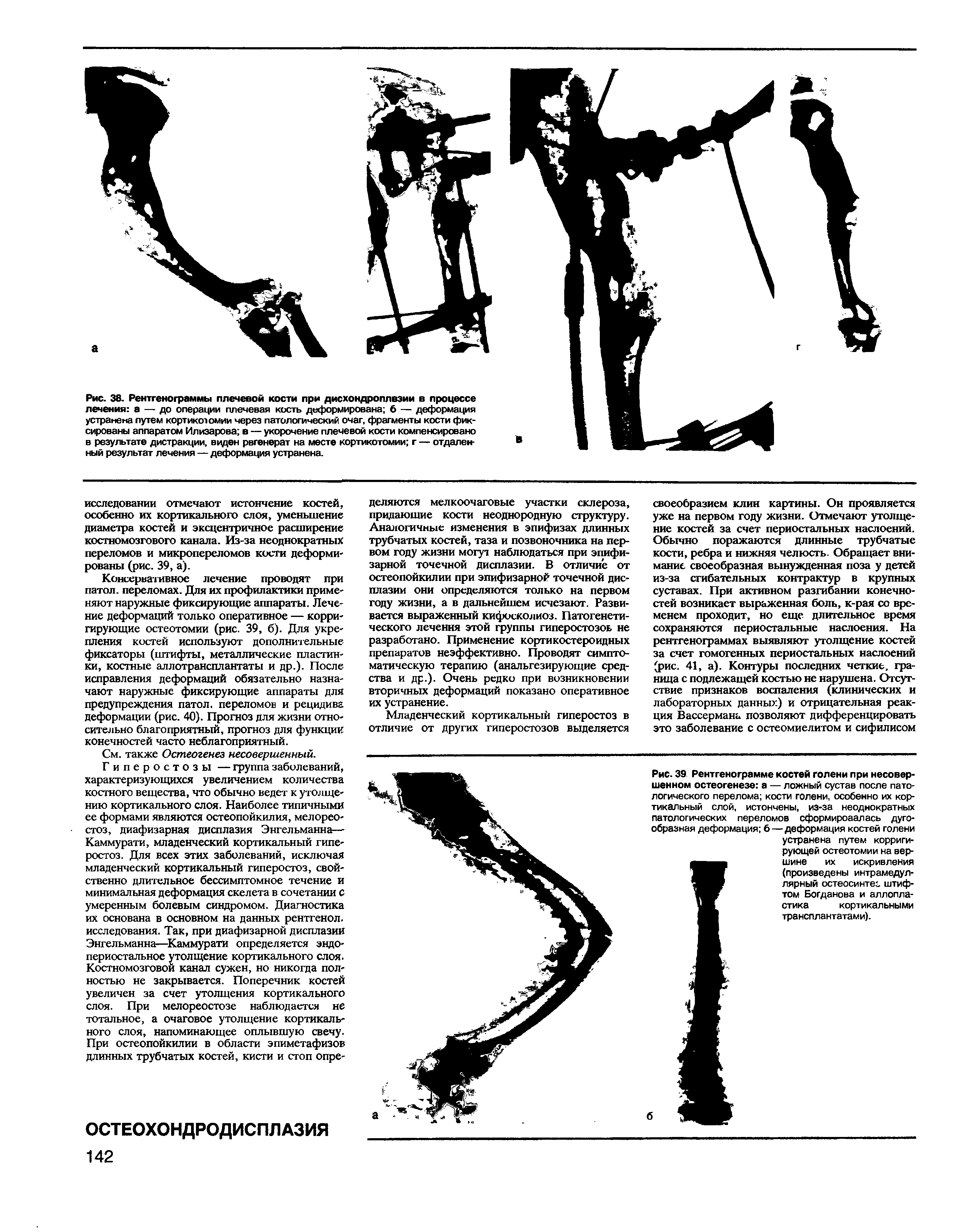 Рис. 39 Рентгенограмме костей голени при несовершенном остеогенезе а — ложный сустав после патологического перелома кости голени, особенно их кортикальный слой, истончены, из-за неоднократных патологических переломов сформировалась дугообразная деформация б — деформация костей голени...