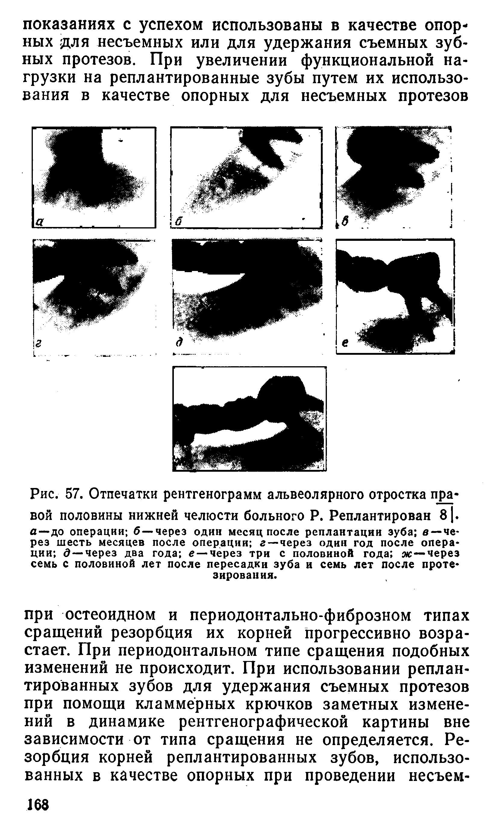 Рис. 57. Отпечатки рентгенограмм альвеолярного отростка пра-вой половины нижней челюсти больного Р. Реплантирован 81. а—до операции б—через один месяц после реплантации зуба в—через шесть месяцев после операции г —через один год после операции д—через два года е — через три с половиной года яс—через семь с половиной лет после пересадки зуба и семь лет после протезирования.