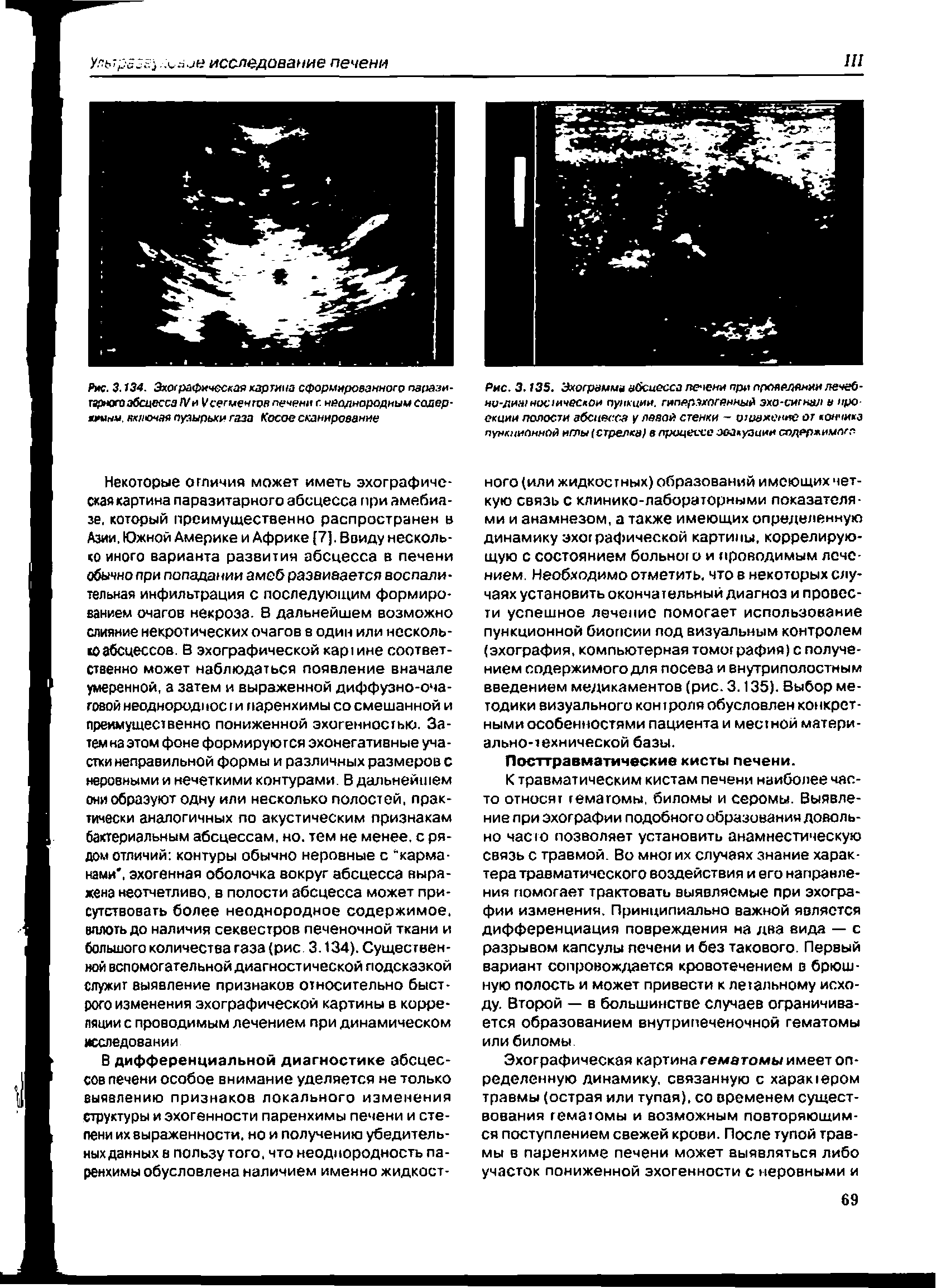 Рис. 3.134. Эхографическая картина сформированного паразитарного абсцесса IVи V сегментов печени с неоднородным содер-яшми. ккиочая пуаырьхи газа Косое сканирование...