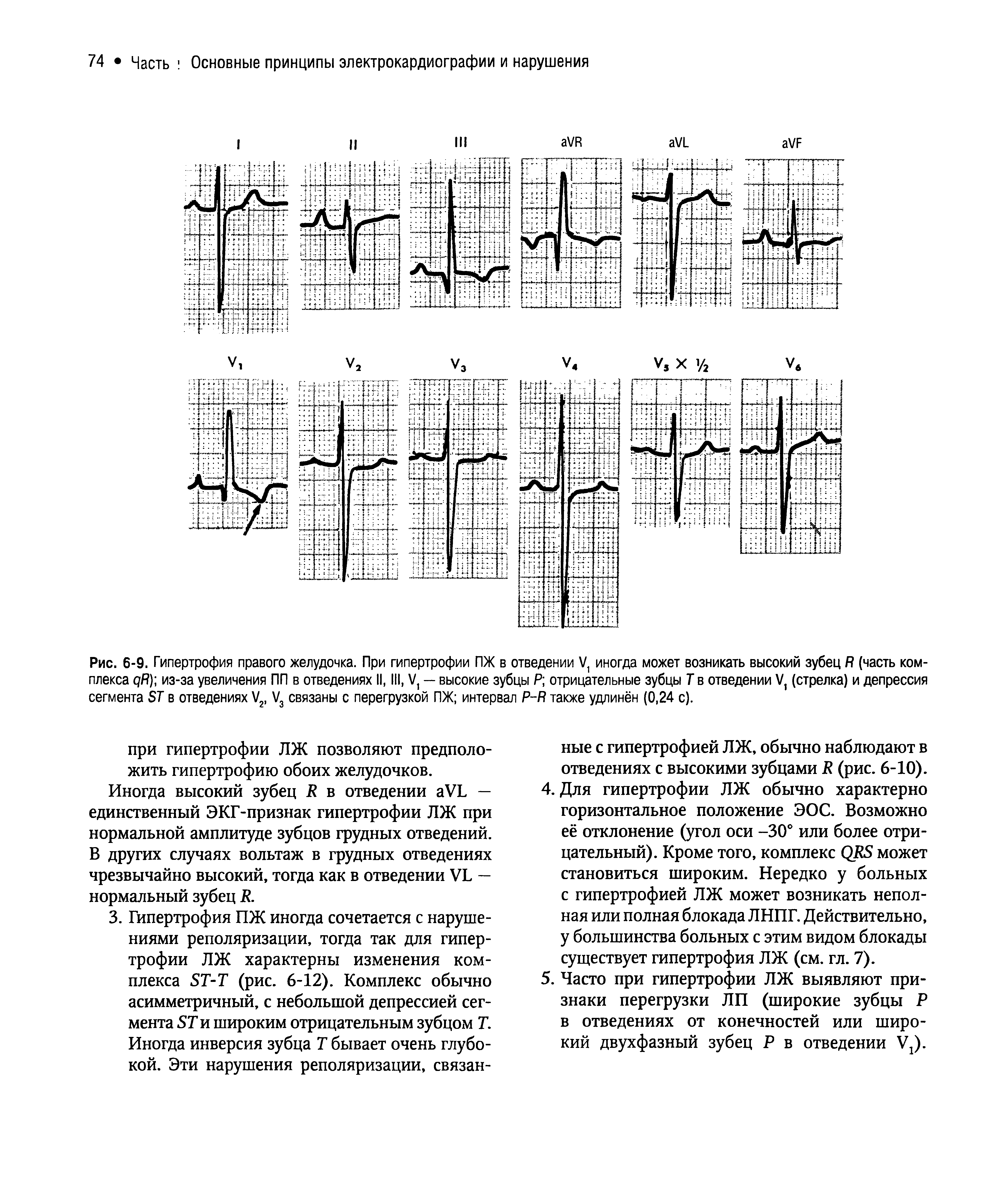 Рис. 6-9. Гипертрофия правого желудочка. При гипертрофии ПЖ в отведении V1 иногда может возникать высокий зубец R (часть комплекса дЯ) из-за увеличения ПП в отведениях II, III, V1 — высокие зубцы Я отрицательные зубцы Т в отведении V1 (стрелка) и депрессия сегмента ST в отведениях V2, V3 связаны с перегрузкой ПЖ интервал P-R также удлинён (0,24 с).