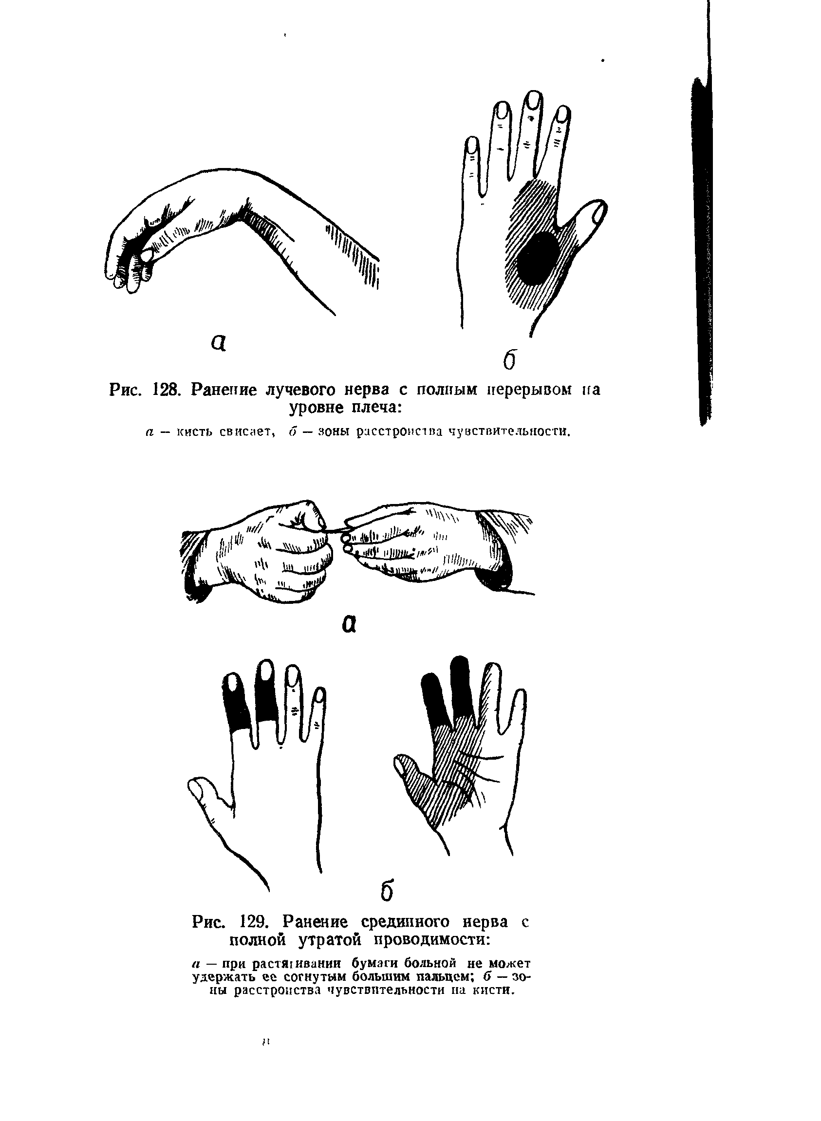 Рис. 129. Ранение срединного нерва с полной утратой проводимости ...