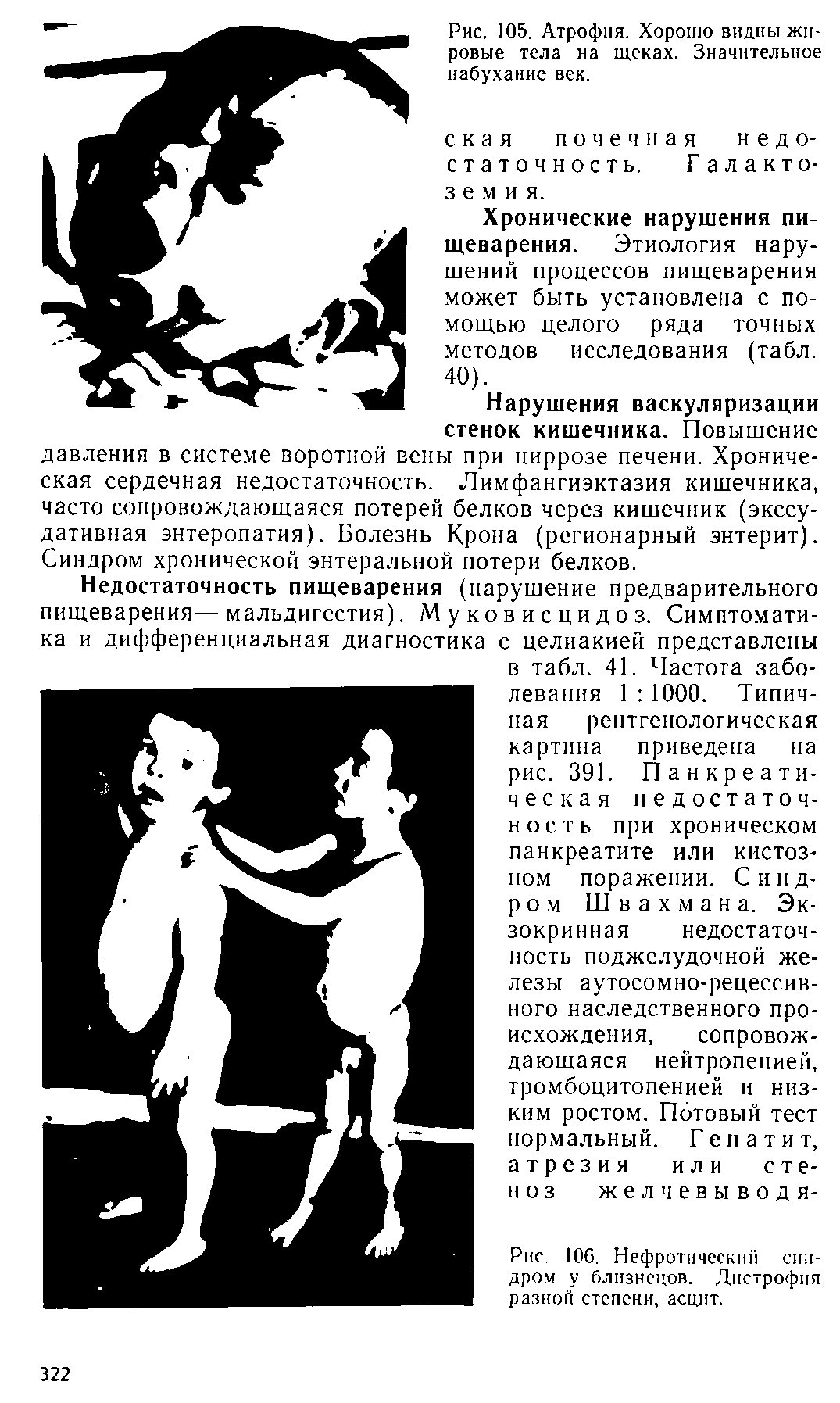 Рис. 106. Нефротический синдром у близнецов. Дистрофия разной степени, асцит.