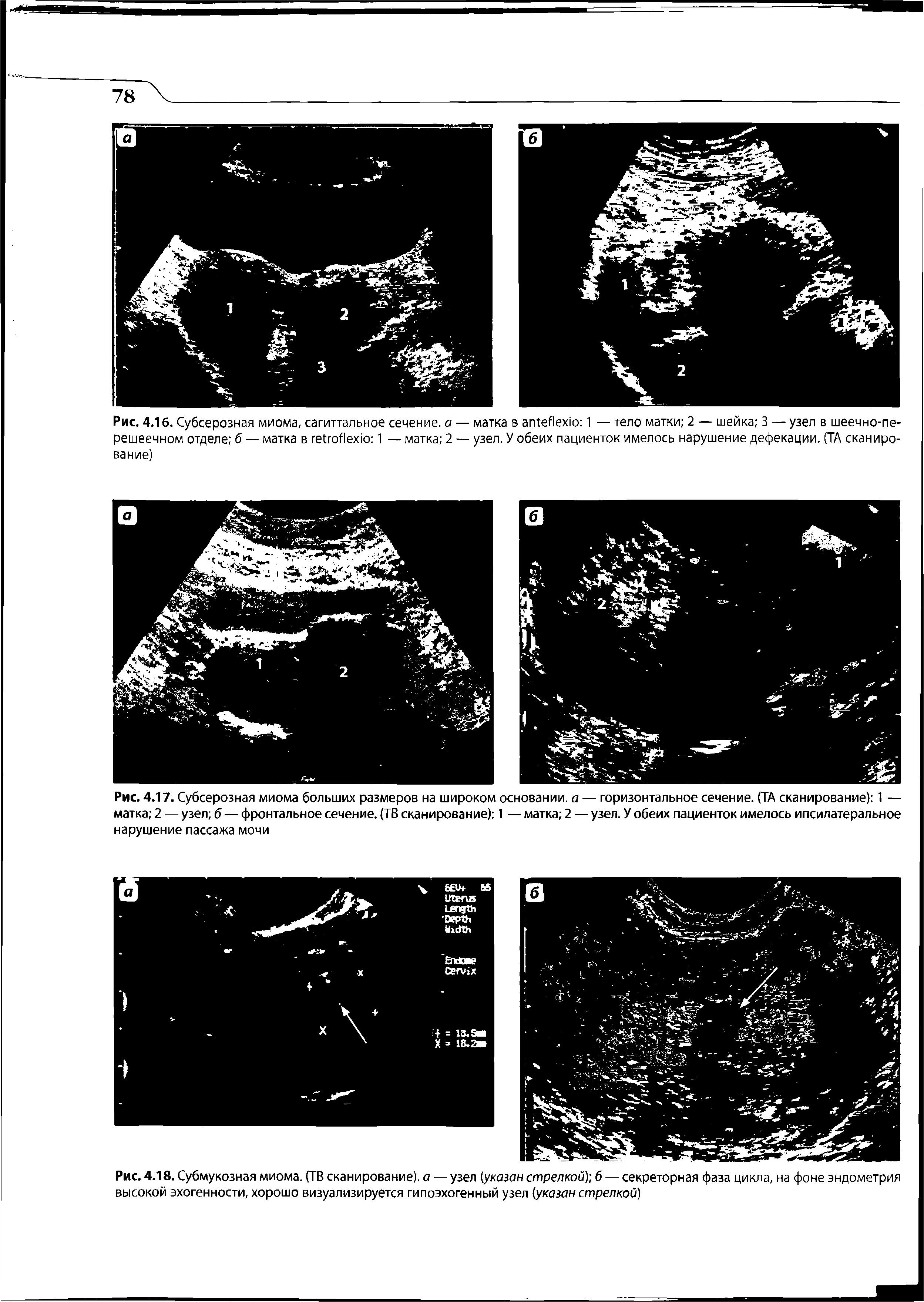 Рис. 4.18. Субмукозная миома. (ТВ сканирование), а — узел (указан стрелкой) б — секреторная фаза цикла, на фоне эндометрия высокой эхогенности, хорошо визуализируется гипоэхогенный узел (указан стрелкой)...