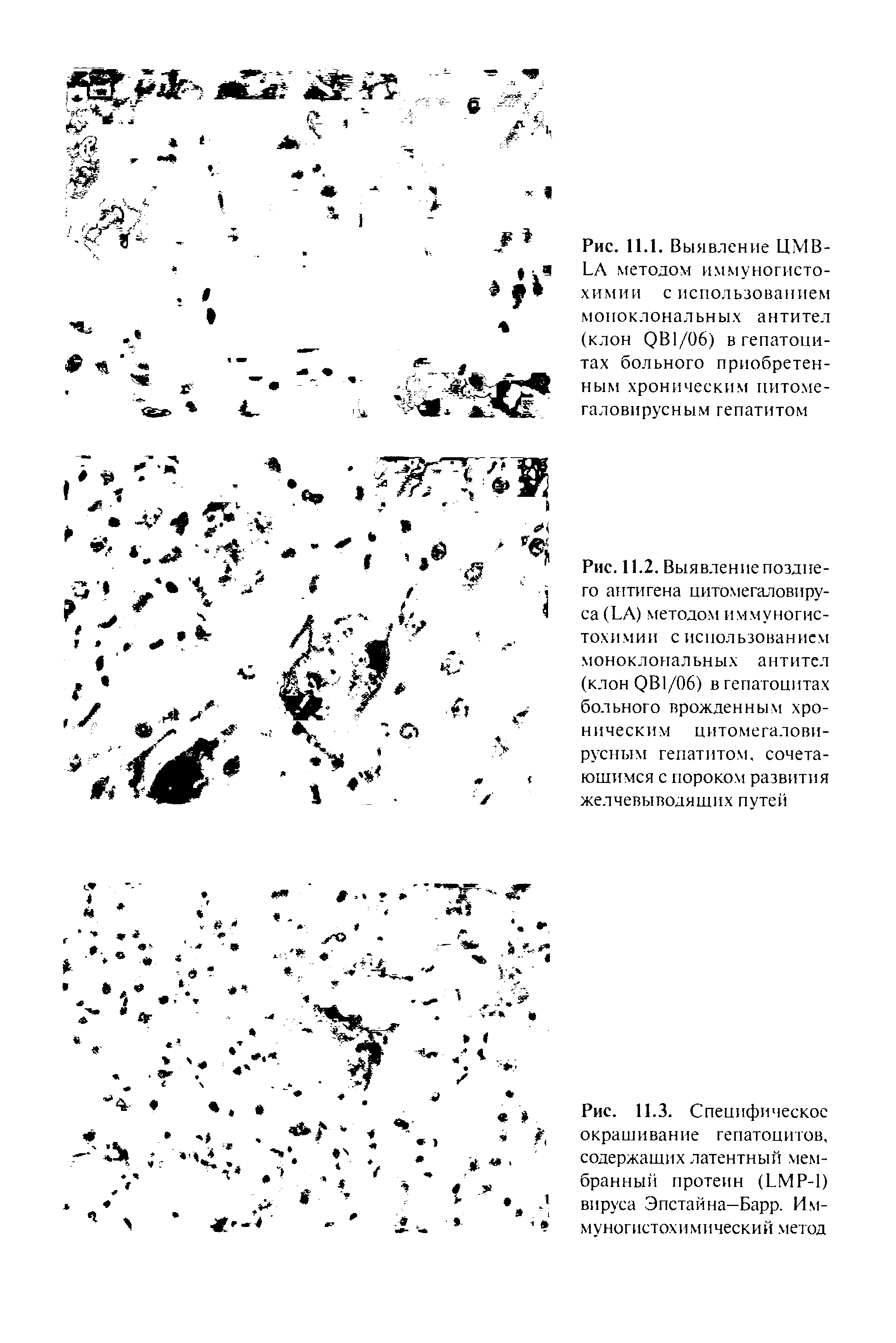 Рис. 11.1. Выявление ЦМВ-БЛ методом иммуногистохимии с использованием моноклональных антител (клон ОВ1/06) в гепатоцитах больного приобретенным хроническим цитомегаловирусным гепатитом...