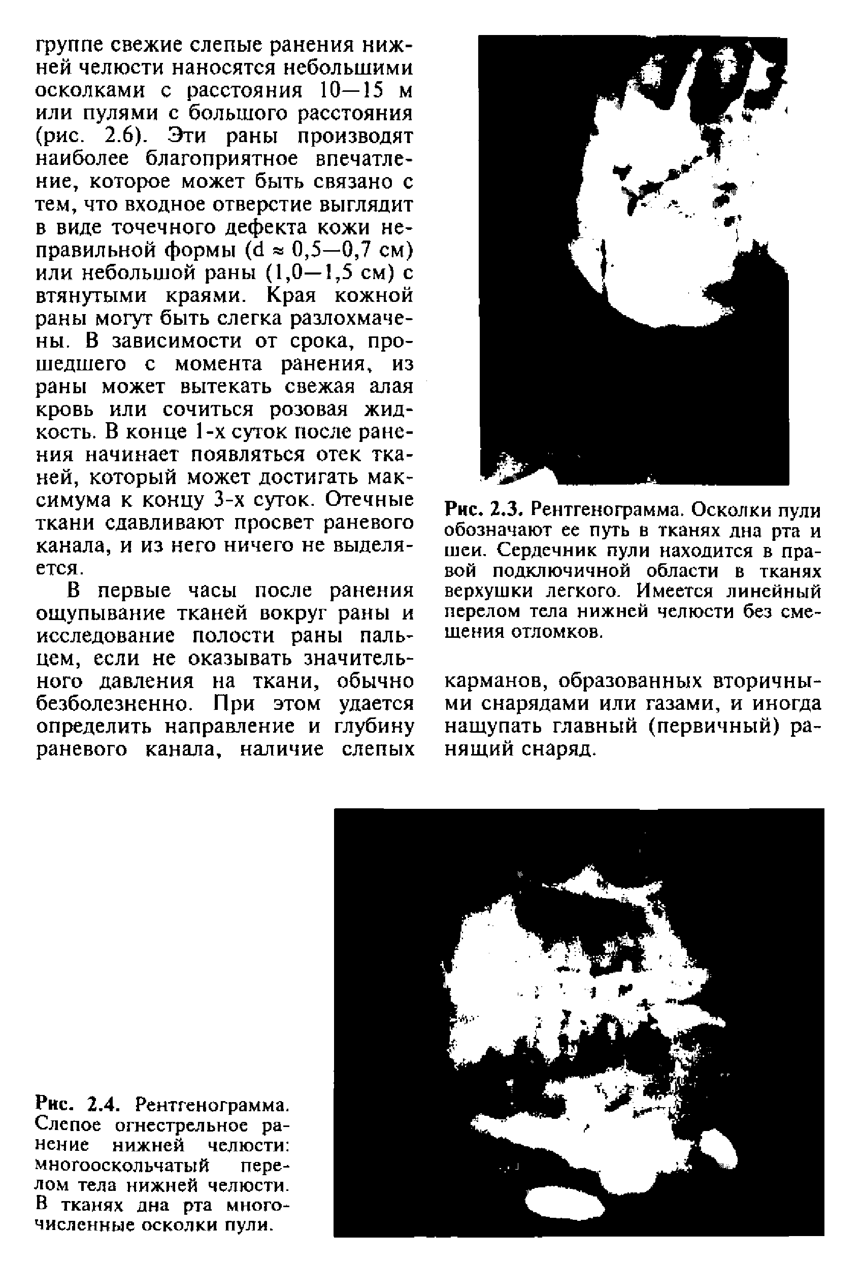 Рис. 2.3. Рентгенограмма. Осколки пули обозначают ее путь в тканях дна рта и шеи. Сердечник пули находится в правой подключичной области в тканях верхушки легкого. Имеется линейный перелом тела нижней челюсти без смешения отломков.