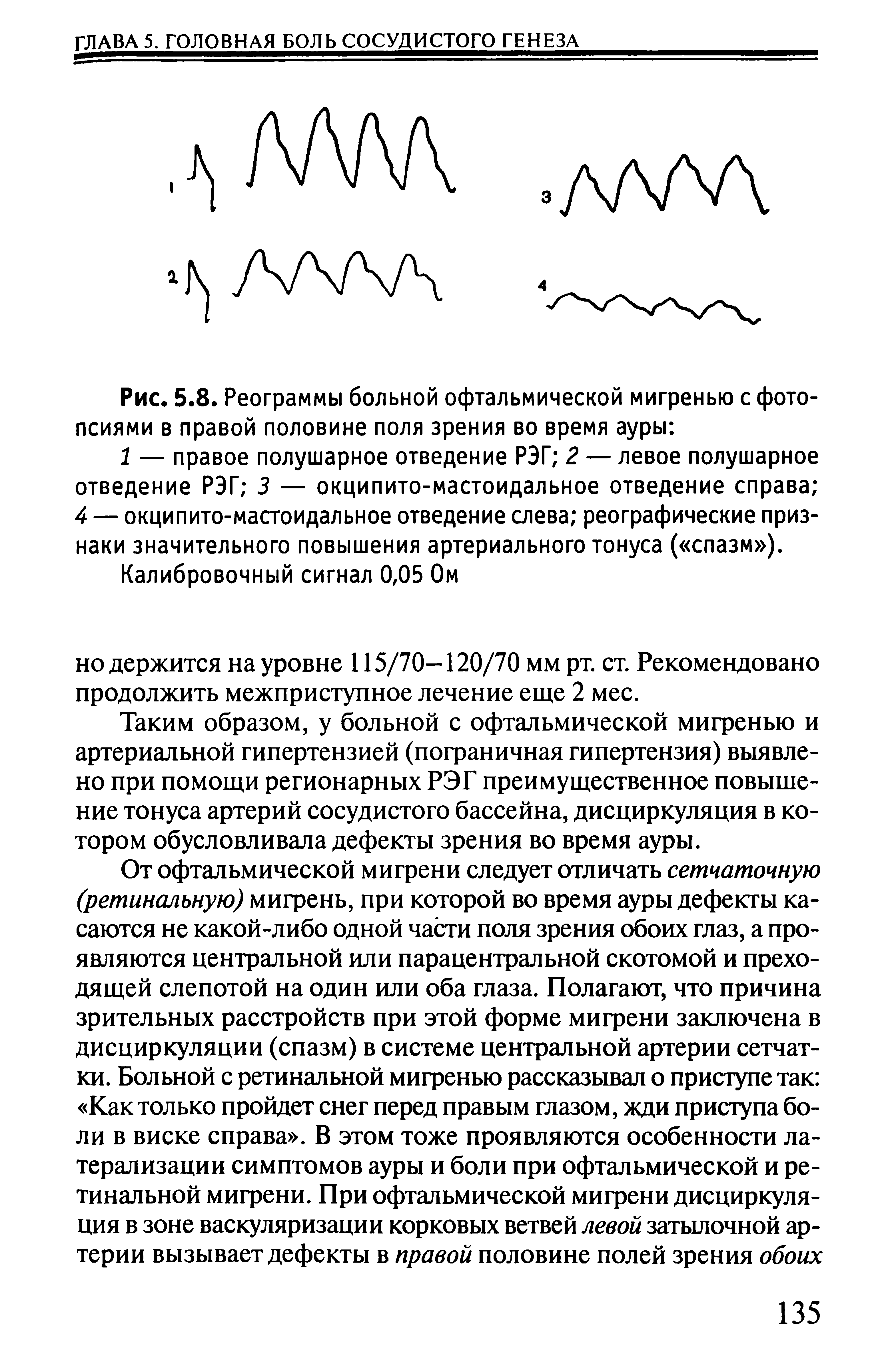 Рис. 5.8. Реограммы больной офтальмической мигренью с фото-псиями в правой половине поля зрения во время ауры ...