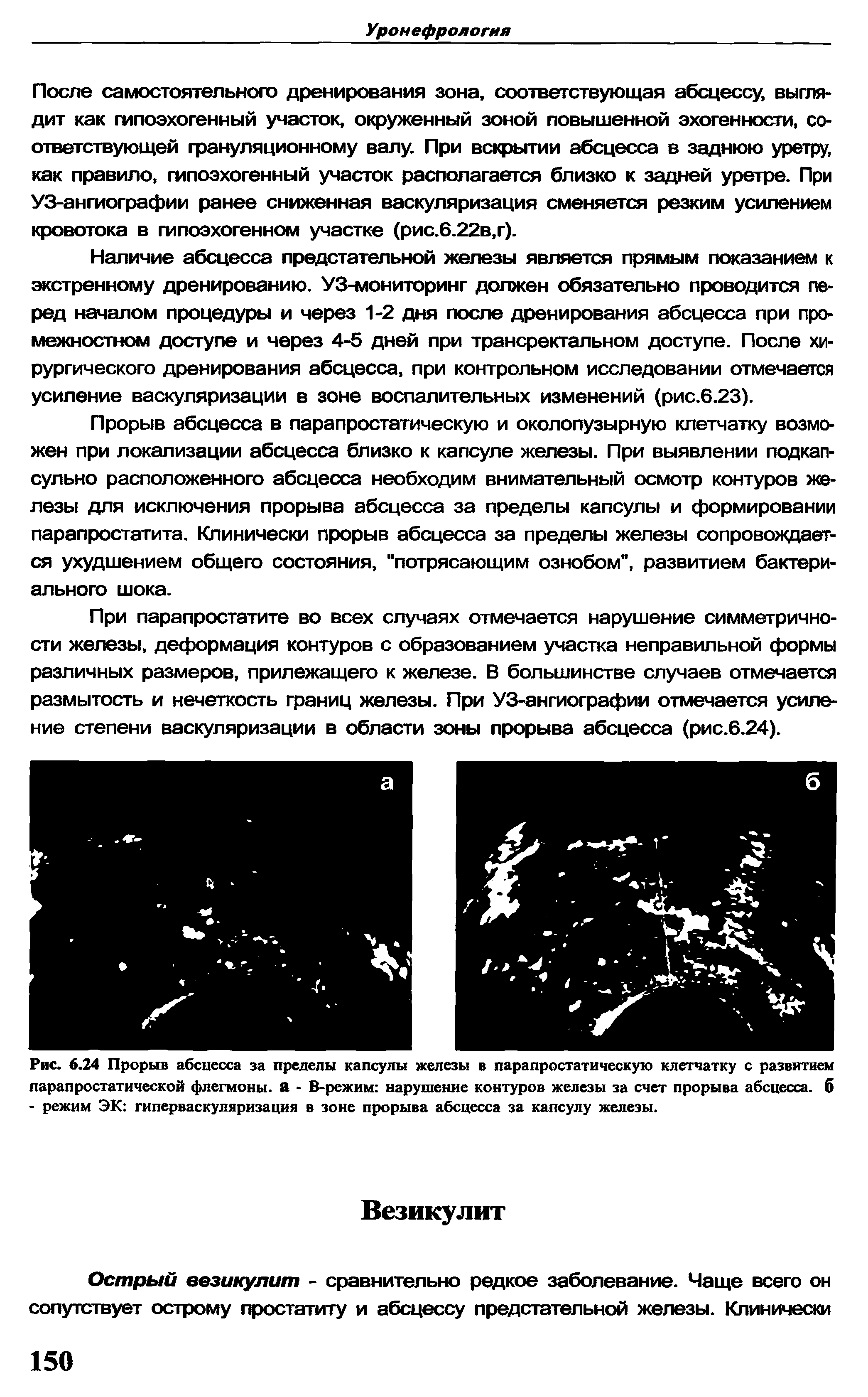 Рис. 6.24 Прорыв абсцесса за пределы капсулы железы в парапростатическую клетчатку с развитием парапростатической флегмоны. Л - В-режим нарушение контуров железы за счет прорыва абсцесса, б - режим ЭК гиперваскуляризация в зоне прорыва абсцесса за капсулу железы.