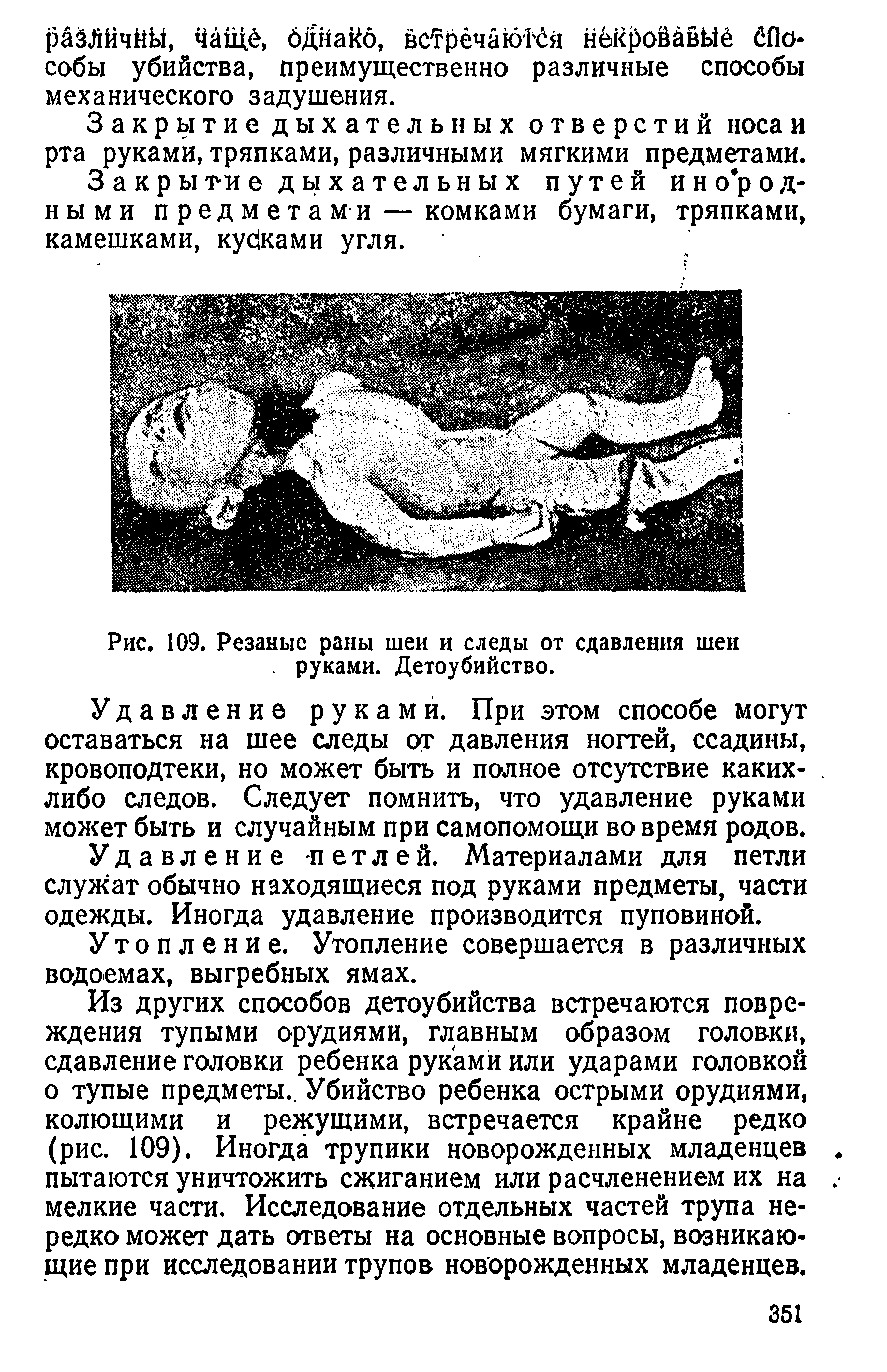 Рис. 109. Резаные раны шеи и следы от сдавления шеи. руками. Детоубийство.