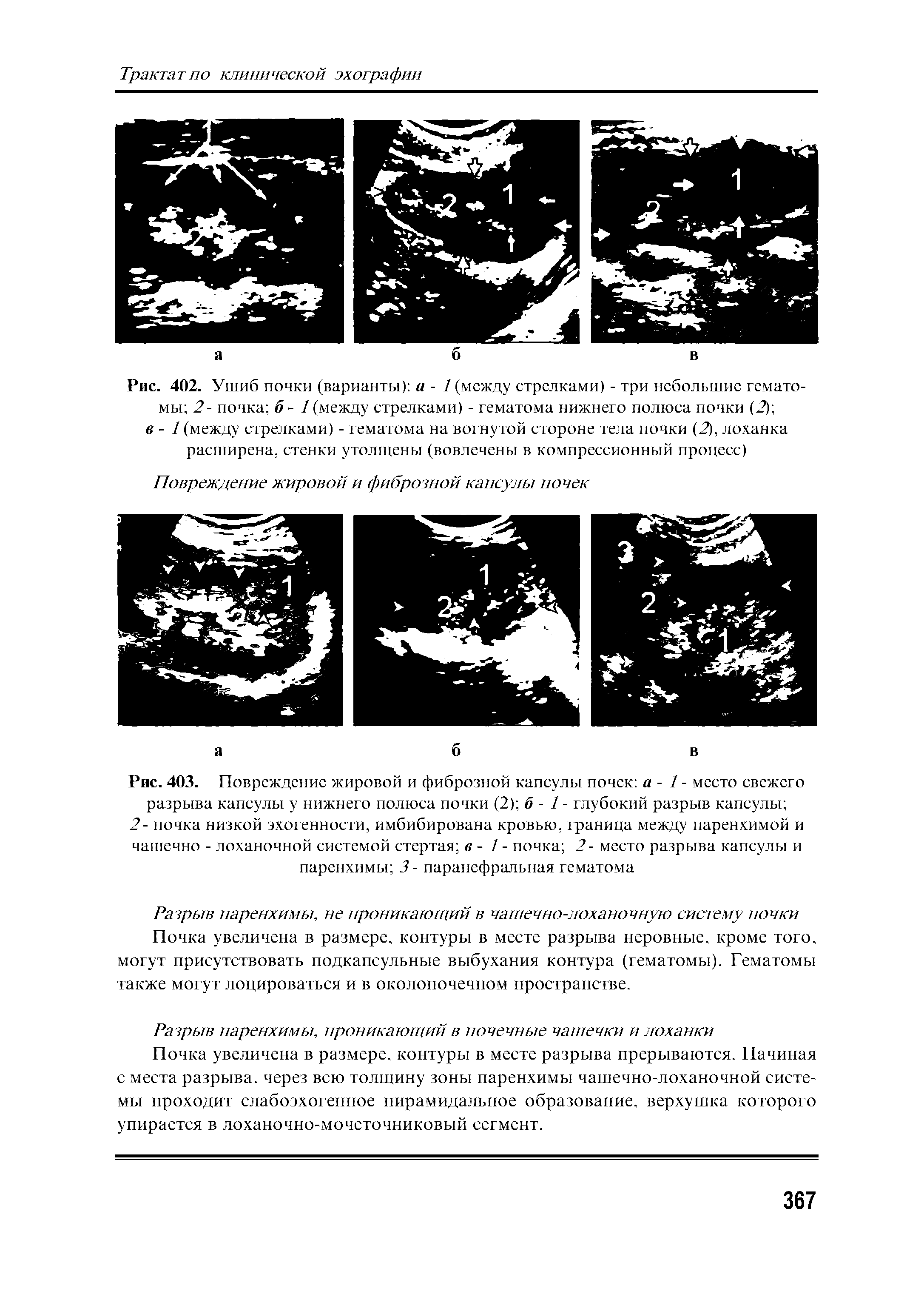 Рис. 403. Повреждение жировой и фиброзной капсулы почек а - / - место свежего разрыва капсулы у нижнего полюса почки (2) б - 1 - глубокий разрыв капсулы ...