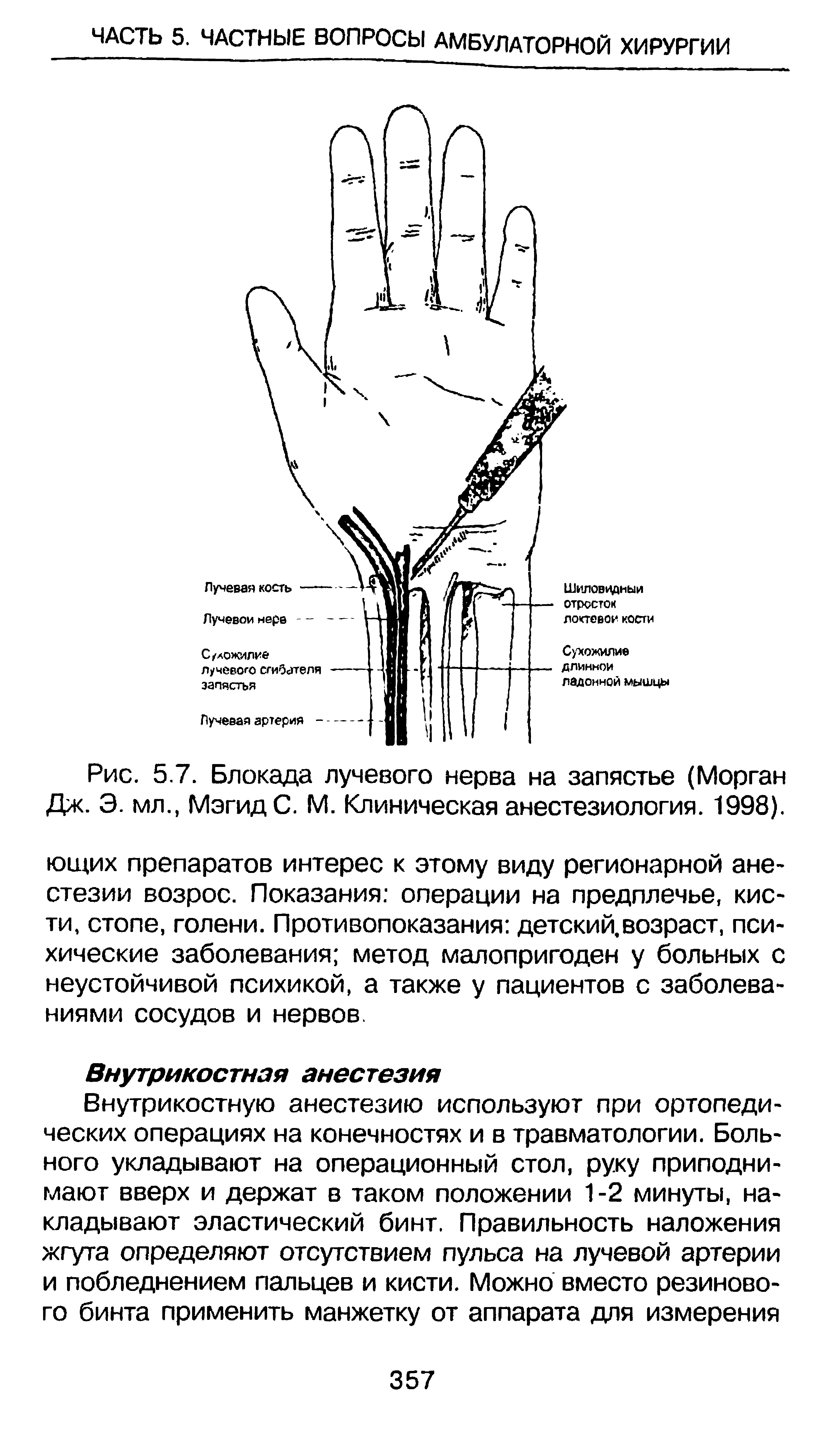 Рис. 5.7. Блокада лучевого нерва на запястье (Морган Дж. Э. мл., Мэгид С. М. Клиническая анестезиология. 1998).