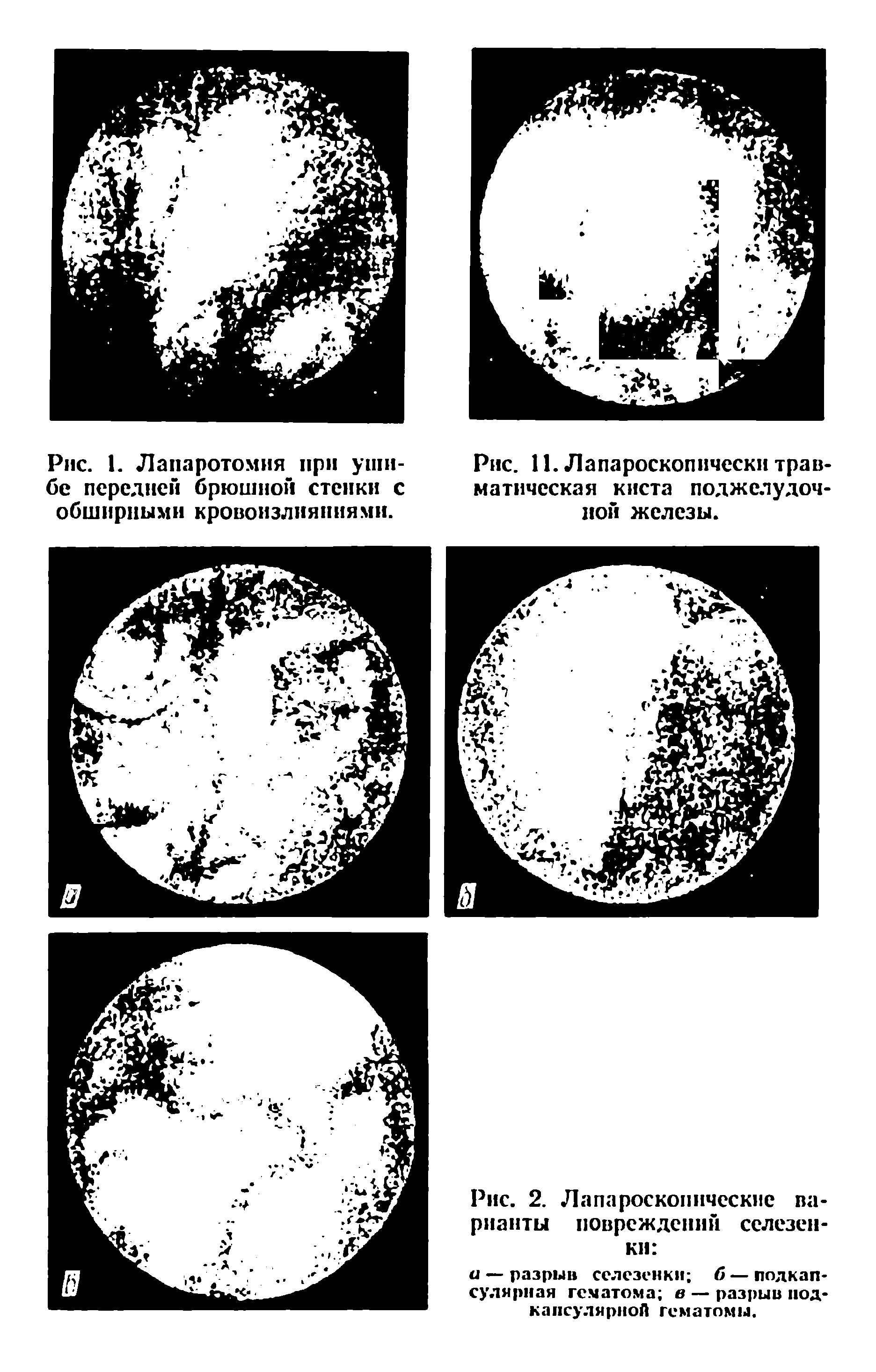 Рис. 1. Лапаротомия при ушибе передней брюшной стенки с обширными кровоизлияниями.