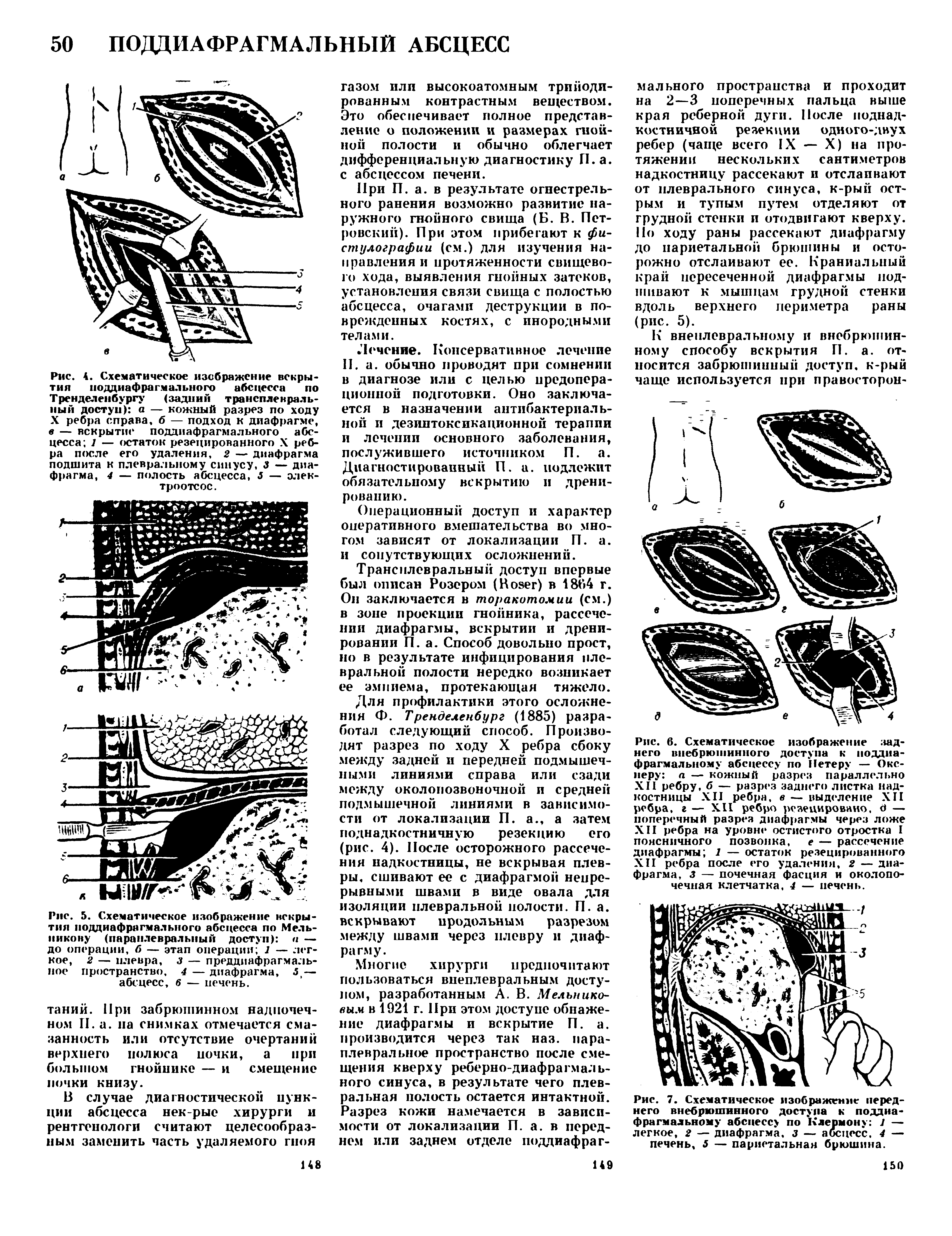 Рис. 5. Схематическое изображение вскрытия поддиафрягмального абсцесса по Мельникову (паранлевральный доступ) а — до операции, б — этап операции 1 — легкое, 2 — плевра, з — преддиафрагмаль-ное пространство, 4 — диафрагма, — абсцесс, 6 — печень.