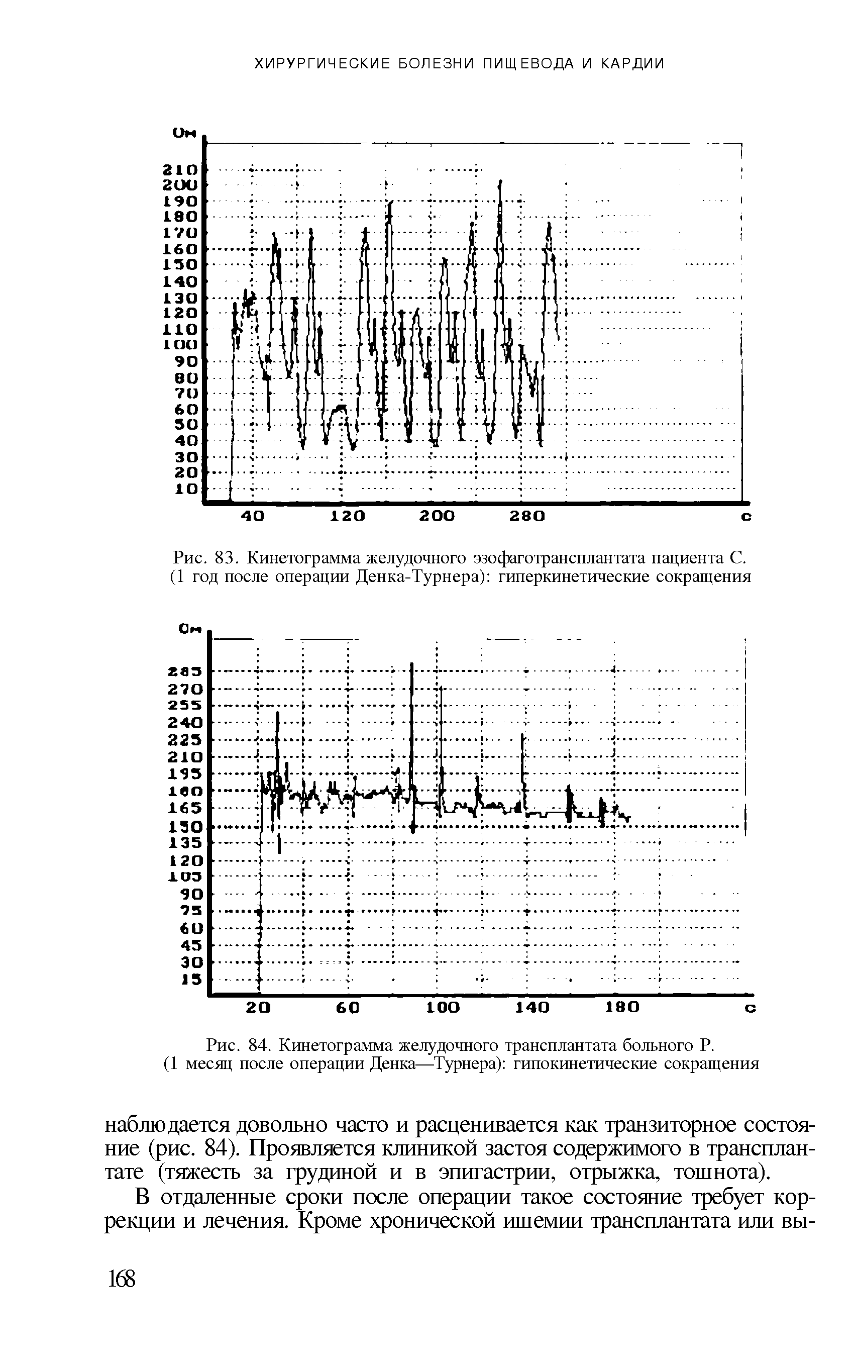 Рис. 83. Кинетограмма желудочного эзофаготрансплантата пациента С. (1 год после операции Денка-Турнера) гиперкинетические сокращения...