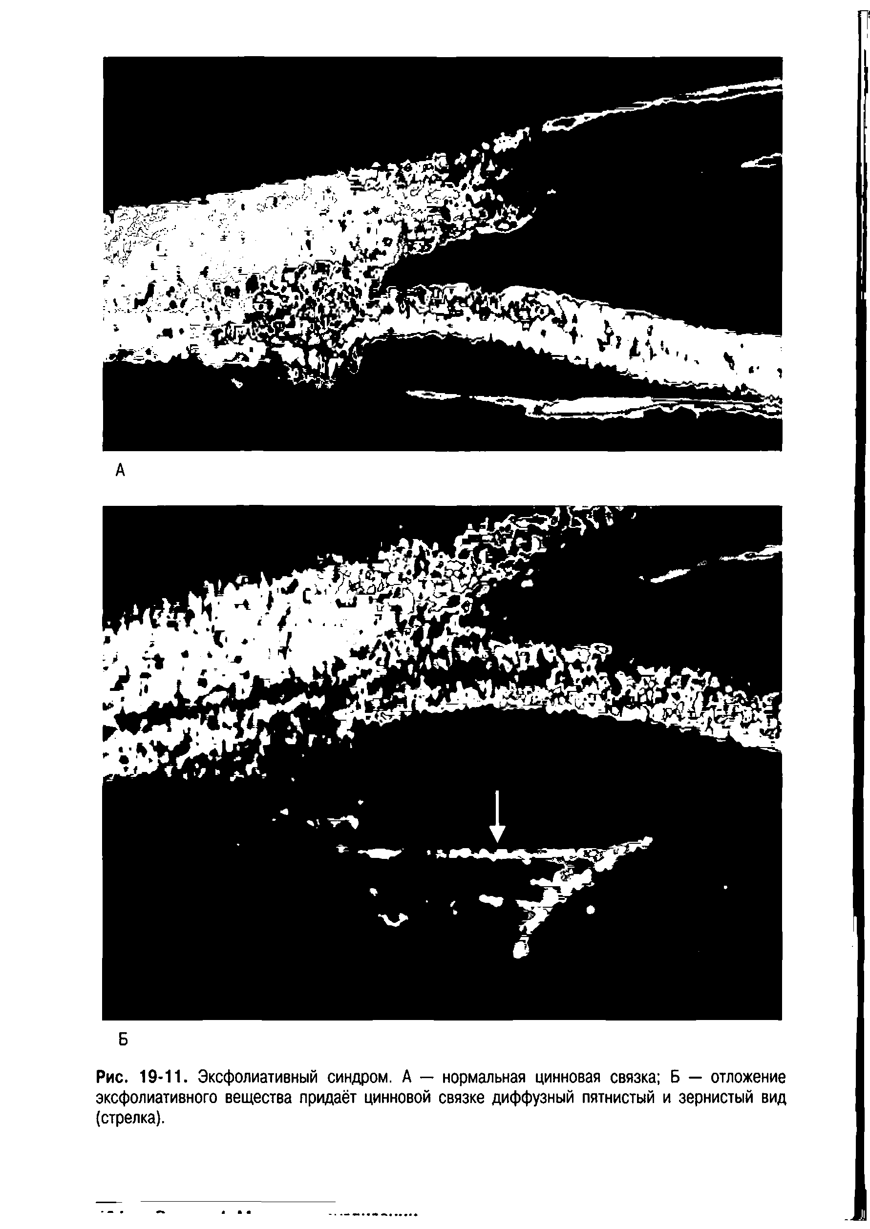 Рис. 19-11. Эксфолиативный синдром. А — нормальная цинновая связка Б — отложение эксфолиативного вещества придаёт цинновой связке диффузный пятнистый и зернистый вид (стрелка).