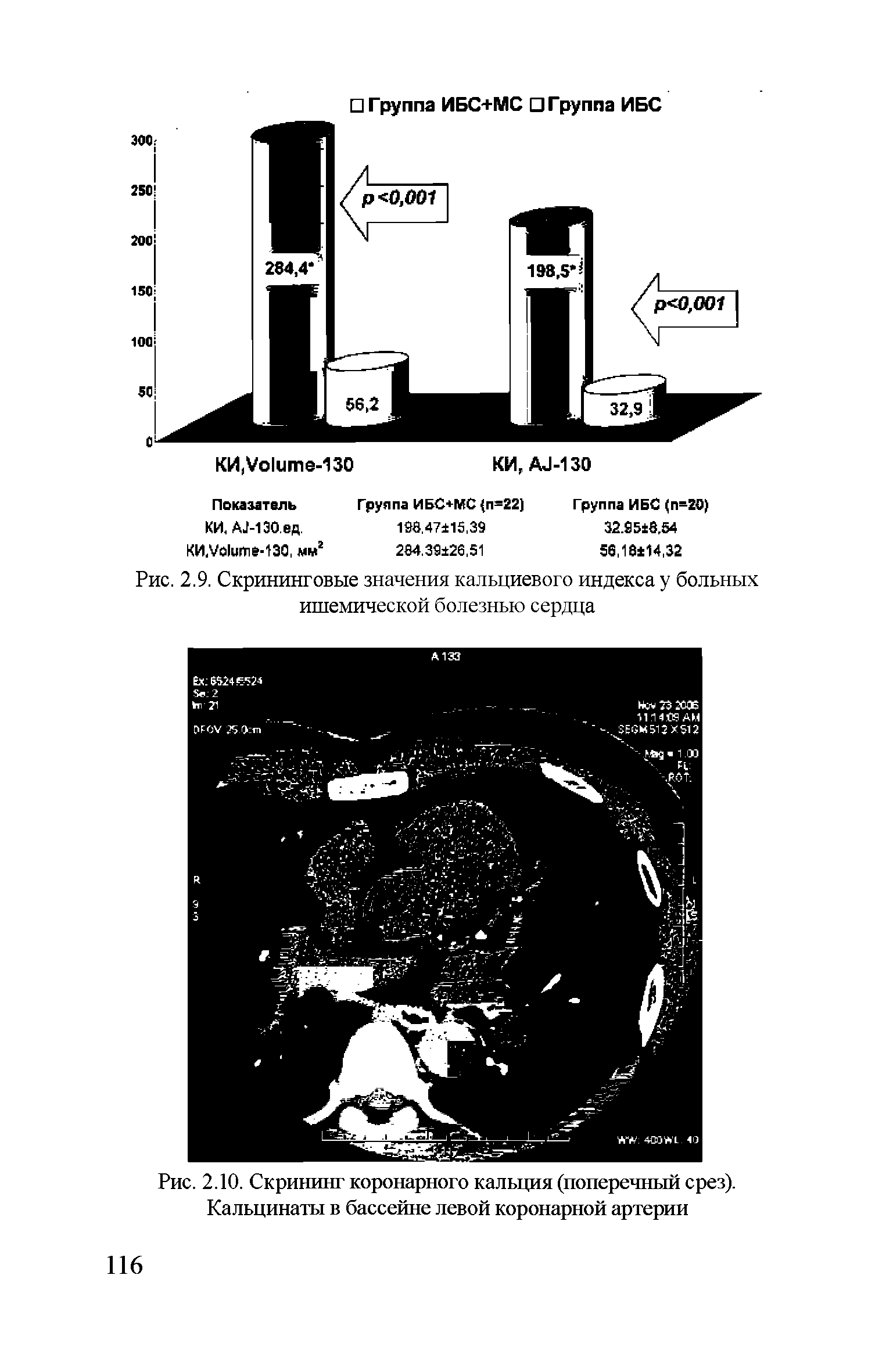 Рис. 2.10. Скрининг коронарного кальция (поперечный срез). Кальцинаты в бассейне левой коронарной артерии...