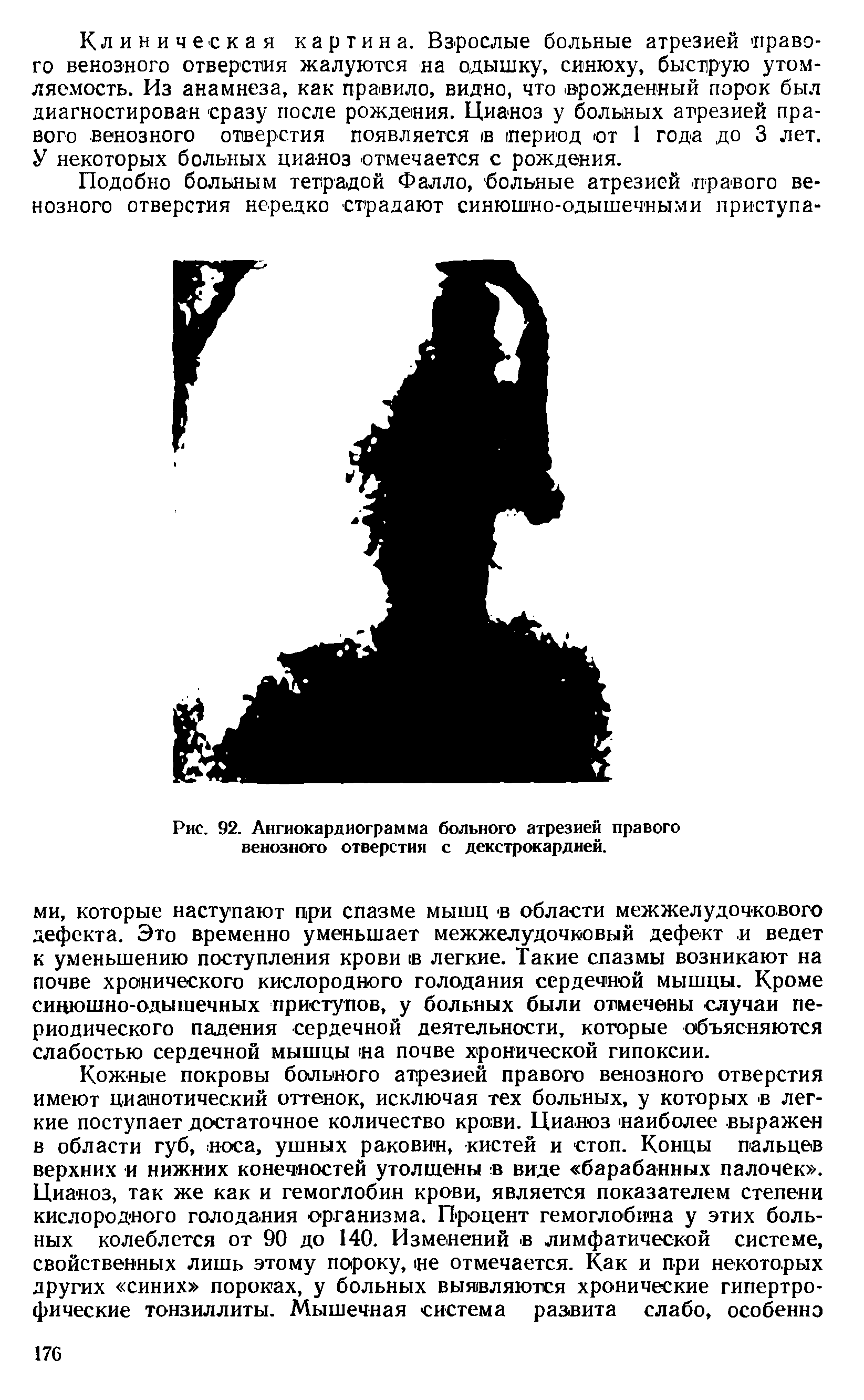 Рис. 92. Ангиокардиограмма больного атрезией правого венозного отверстия с декстрокардией.