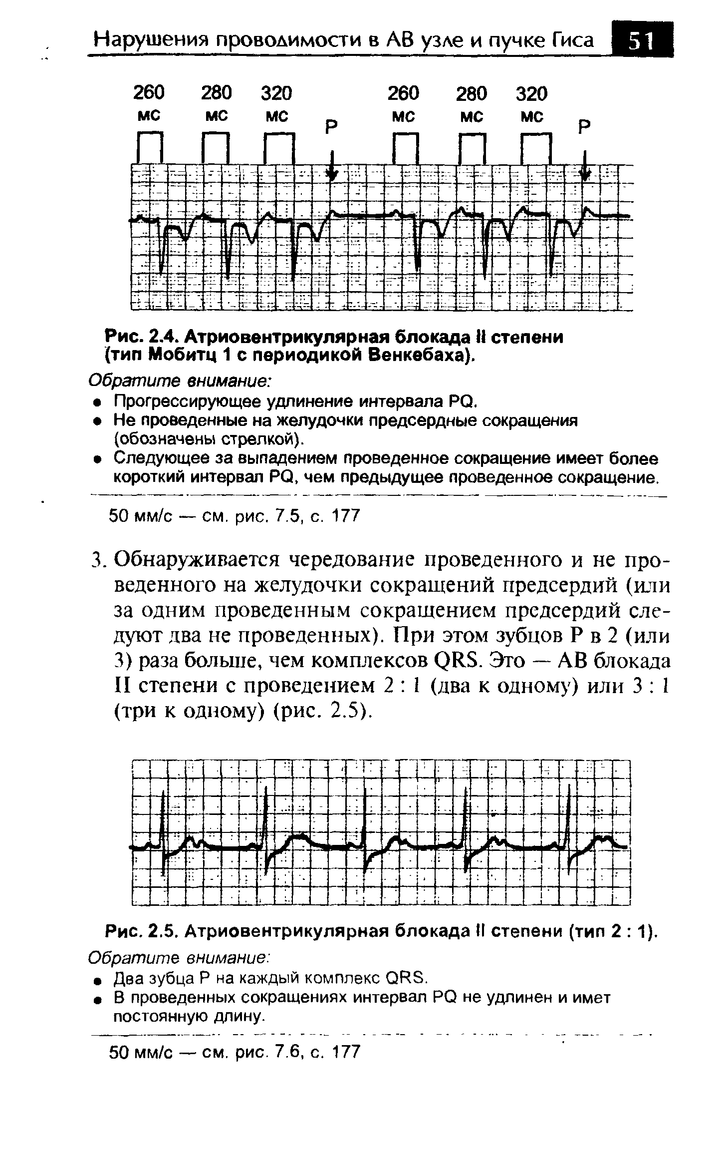 Рис. 2.4. Атриовентрикулярная блокада II степени (тип Мобитц 1 с периодикой Венкебаха).
