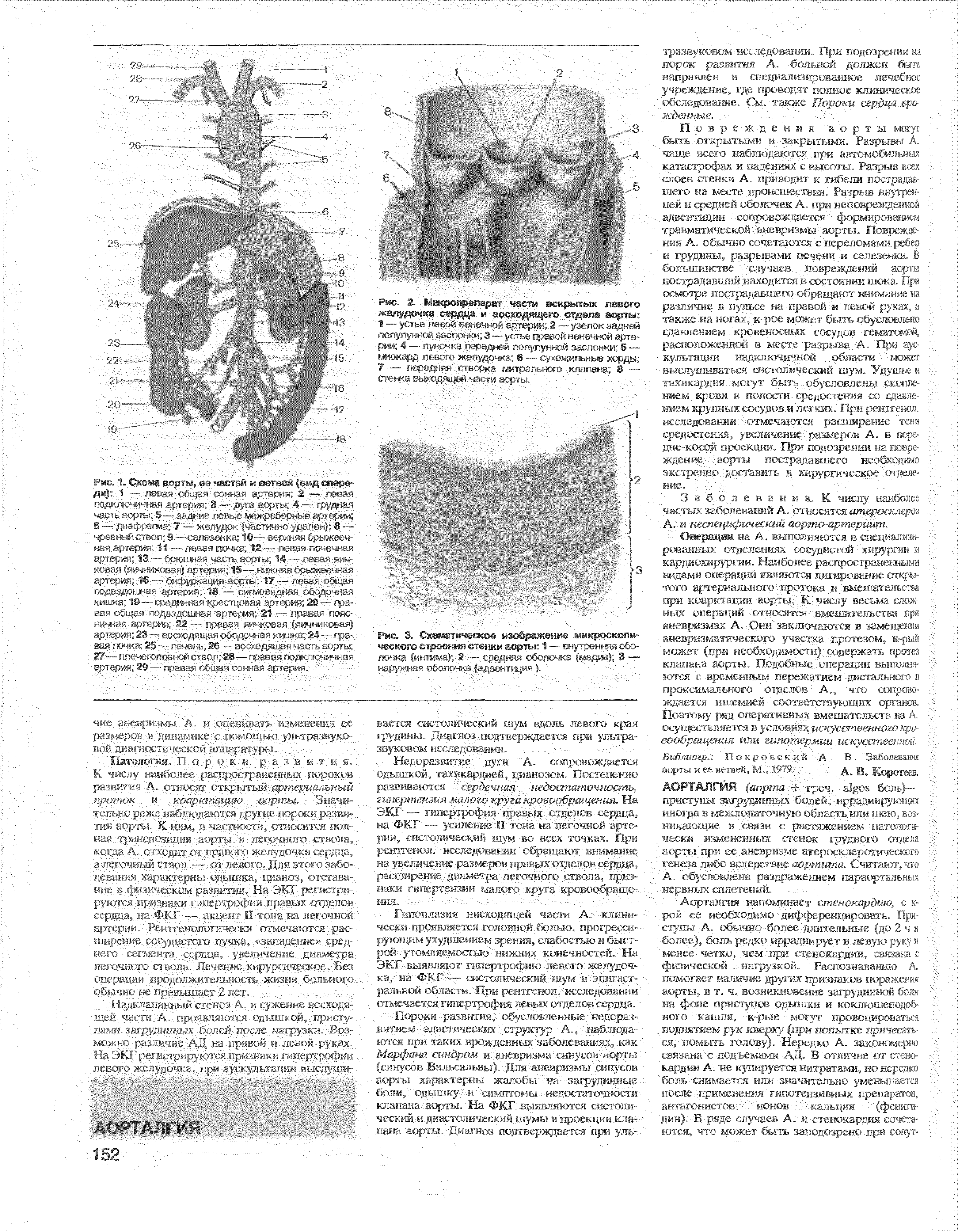 Рис. 2. Макропрепарат части вскрытых левого желудочка сердца и восходящего отдела аорты 1- 1 сто, ем, т >м -шсуиг 2 ( нлокэадней...