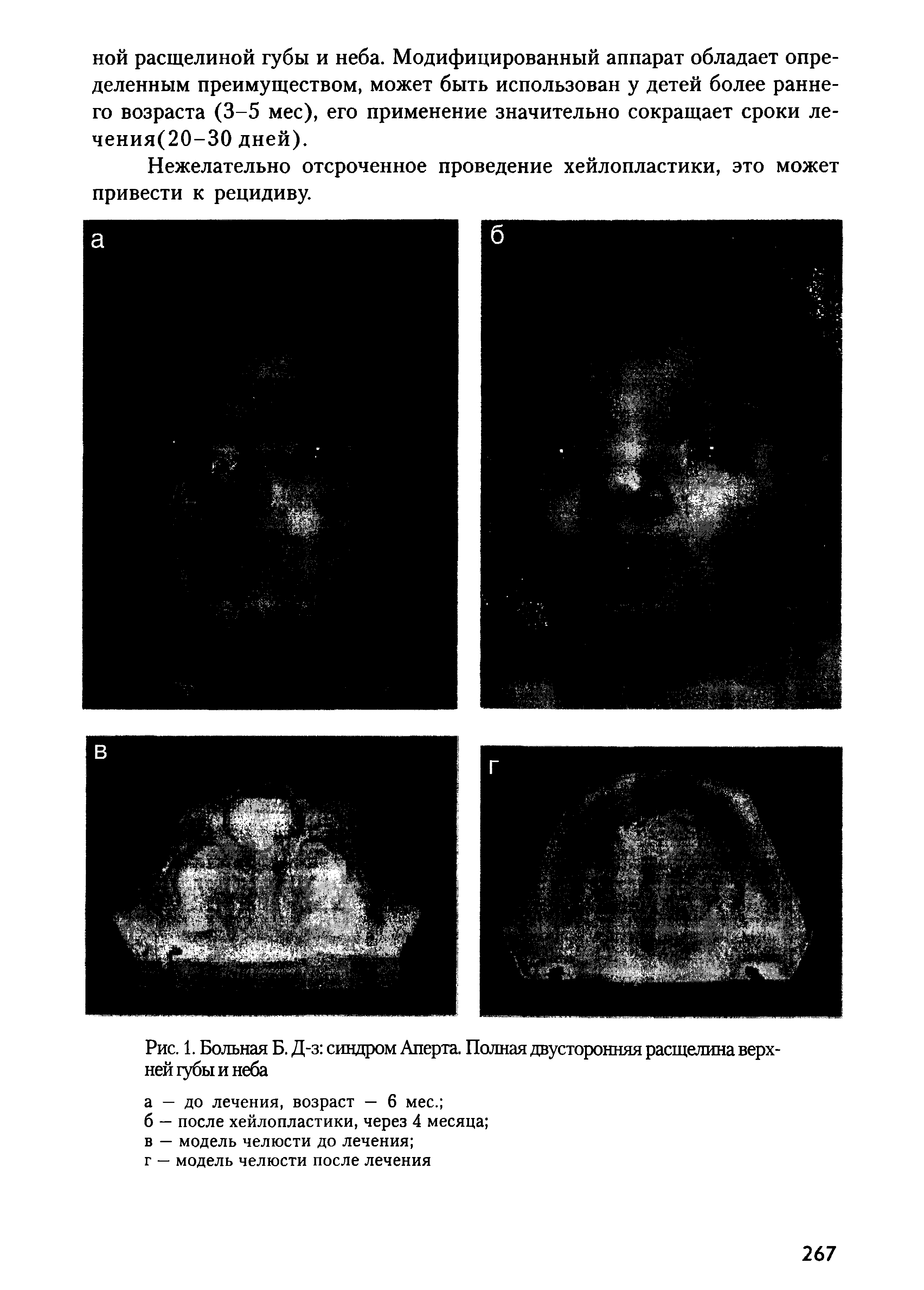 Рис. 1. Больная Б. Д-з синдром Аперта. Полная двусторонняя расщелина верхней губы и неба...