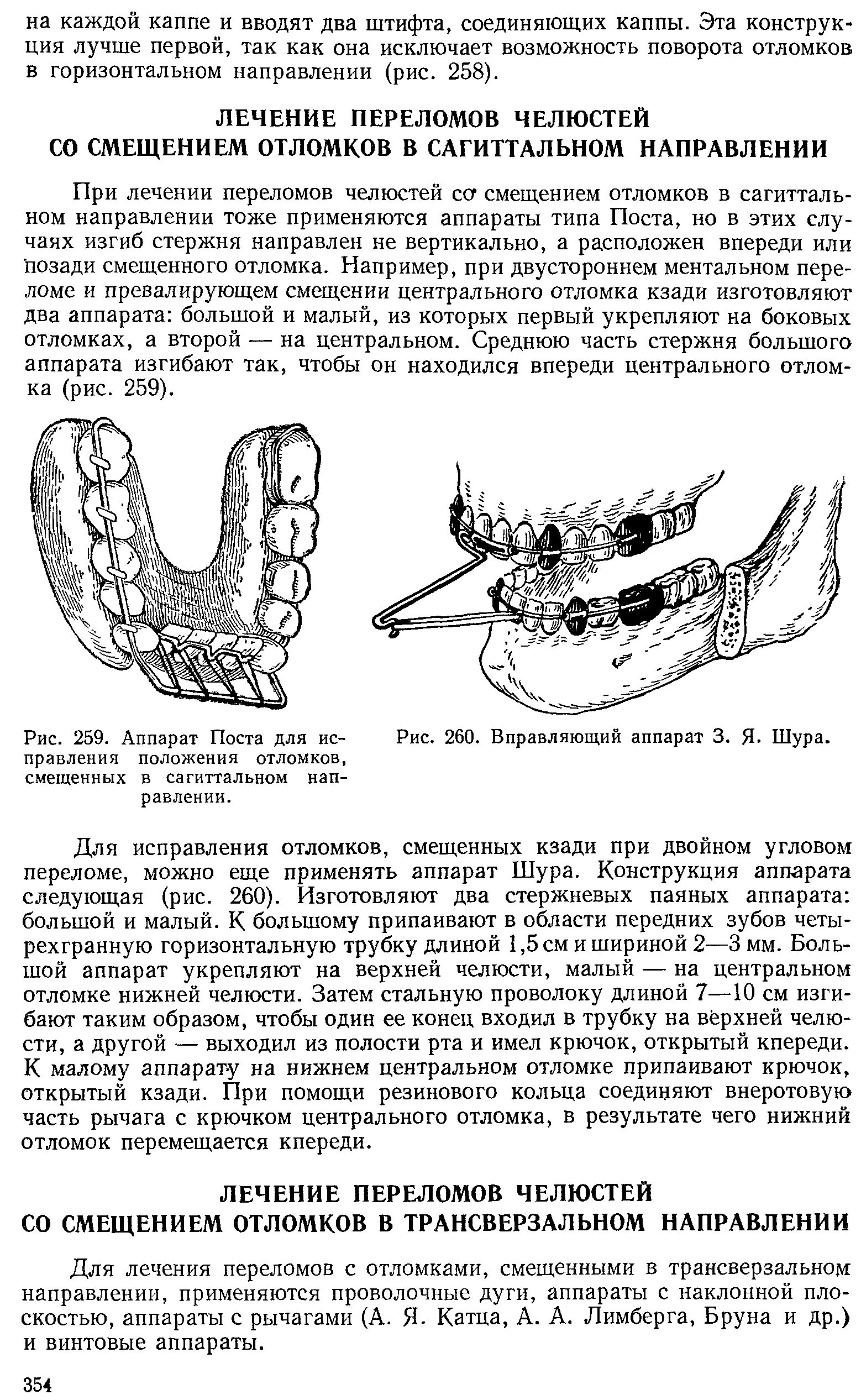 Рис. 259. Аппарат Поста для исправления положения отломков, смещенных в сагиттальном направлении.