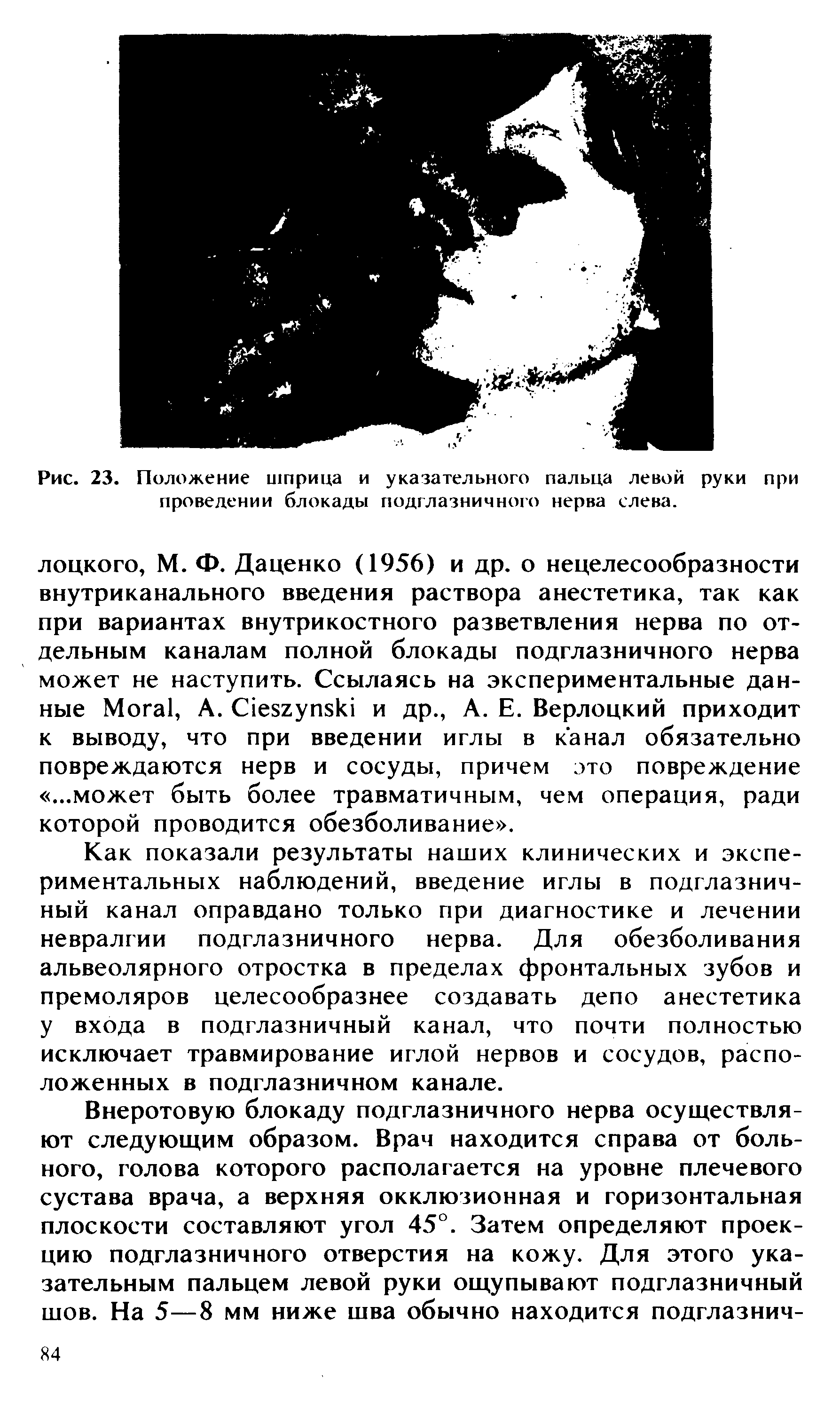 Рис. 23. Положение шприца и указательного пальца левой руки при проведении блокады подглазничного нерва слева.