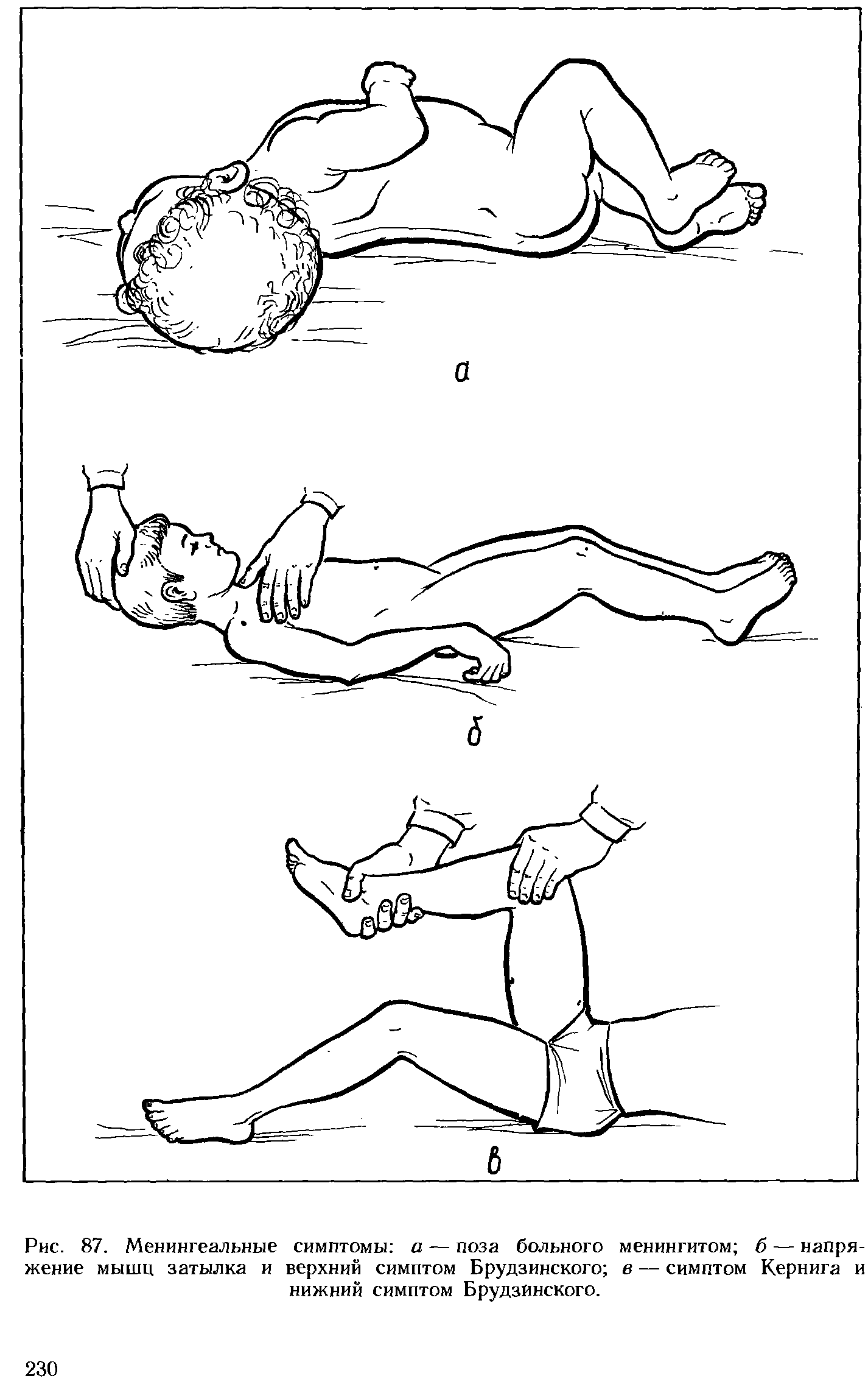 Рис. 87. Менингеальные симптомы а — поза больного менингитом б — напряжение мышц затылка и верхний симптом Брудзинского в — симптом Кернига и нижний симптом Брудзинского.